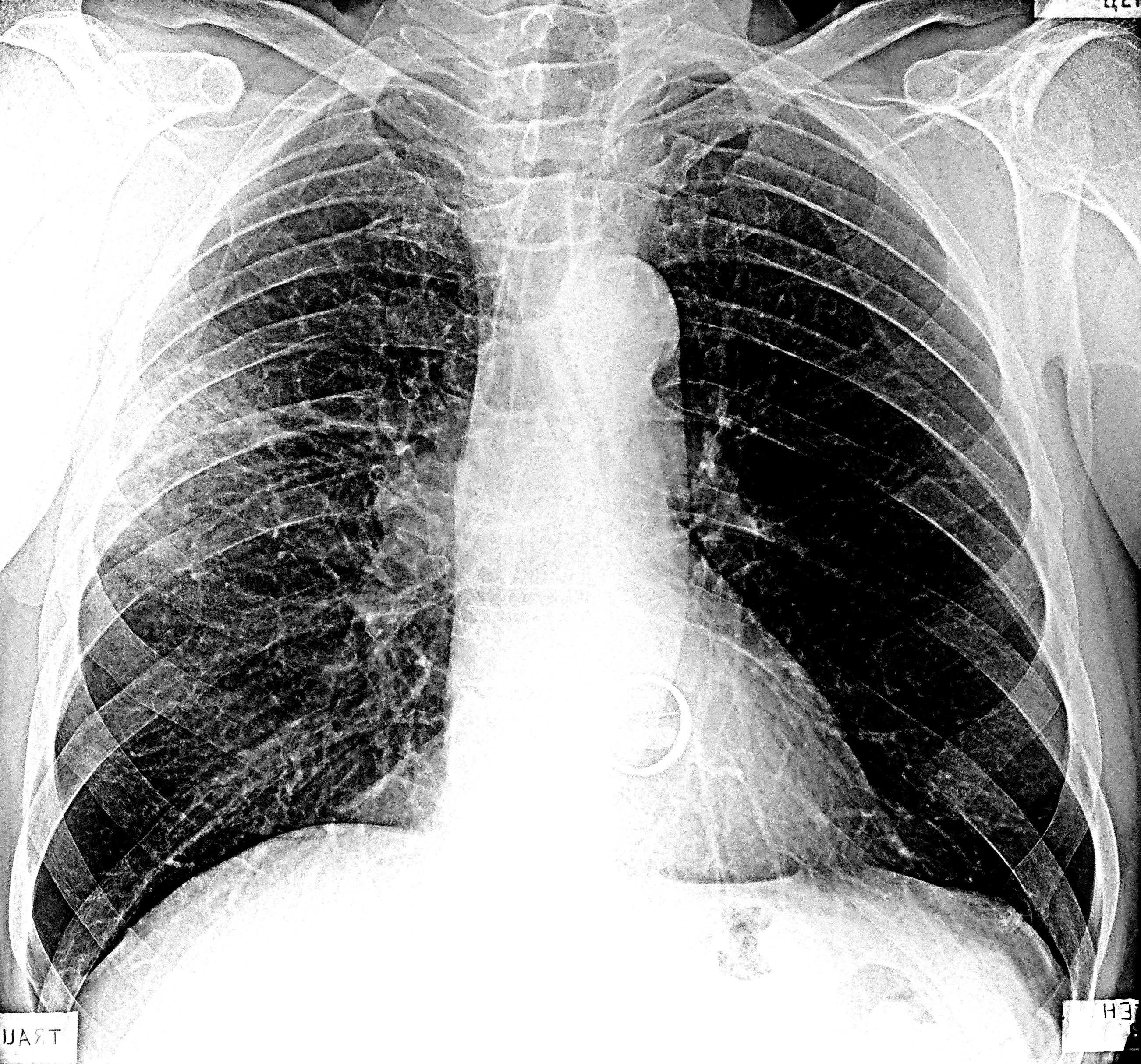 10 поражение легких. Пневмония легкого рентгенограмма. Очаговая пневмония рентген снимок. Рентгенография грудной клетки пневмония. Рентген грудной клетки пневмония.