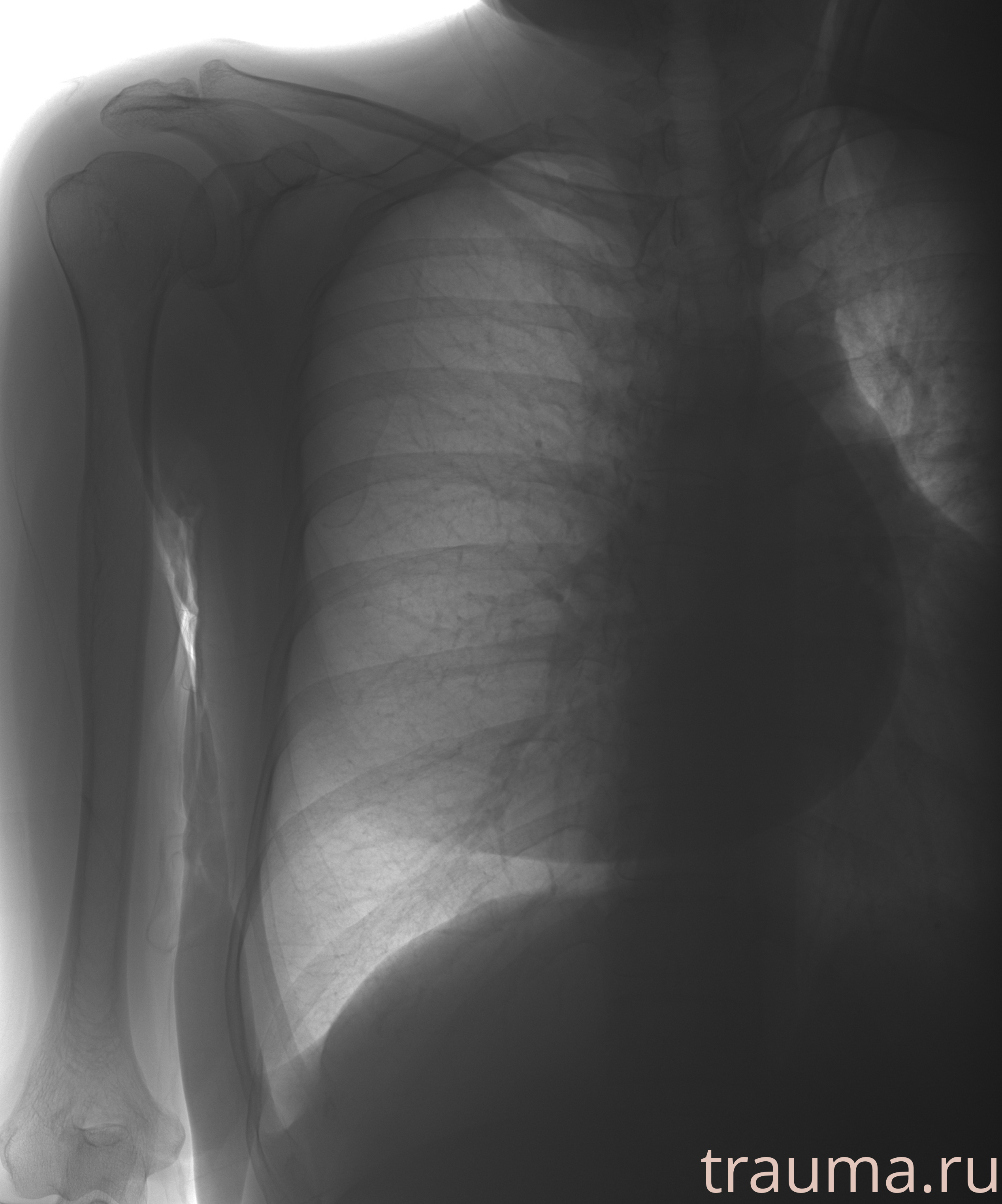 Рентген на дому: по вашему адресу приезжает врач-рентгенолог, травматолог-ортопед с мобильным рентгеновским аппаратом, проводит диагностику травмы или заболевания, делает необходимые рентгенограммы, дает рекомендации по дальнейшему лечению. Получить качественные снимки в домашних условиях возможно благодаря уникальной методике, разработанной МосРентген Центром для института  Склифосовского