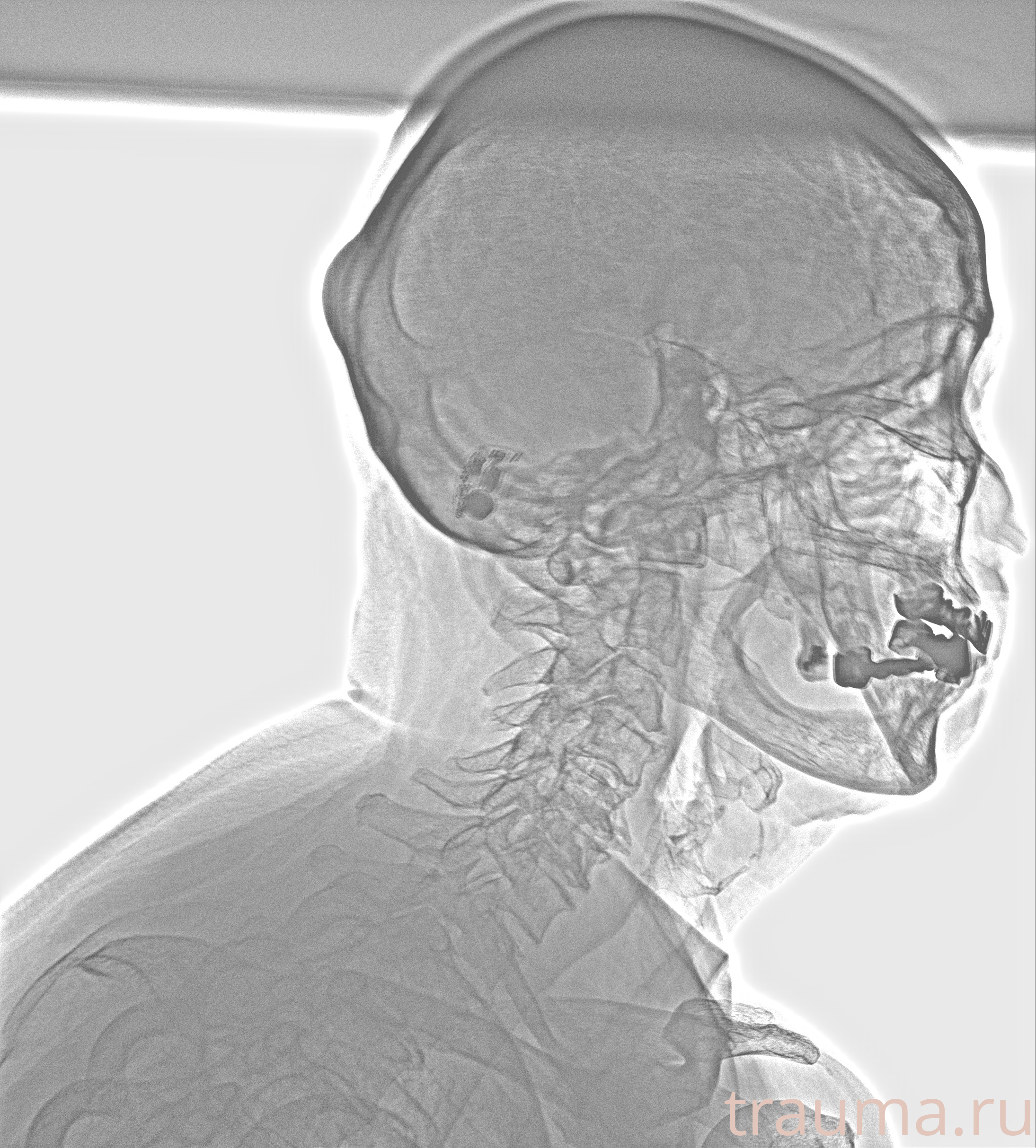 Рентген на дому: по вашему адресу приезжает врач-рентгенолог, травматолог-ортопед с мобильным рентгеновским аппаратом, проводит диагностику травмы или заболевания, делает необходимые рентгенограммы, дает рекомендации по дальнейшему лечению. Получить качественные снимки в домашних условиях возможно благодаря уникальной методике, разработанной МосРентген Центром для института  Склифосовского