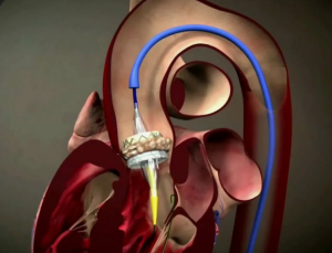 Отдаленные результаты коррекции тяжелого аортального стеноза с использованием кардиохирургических и эндоваскулярных методов по данным контроля лучевыми методами