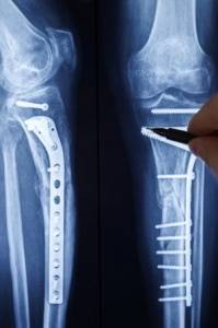 Восстановление покровных тканей у пострадавших с тяжелыми открытыми переломами костей голени