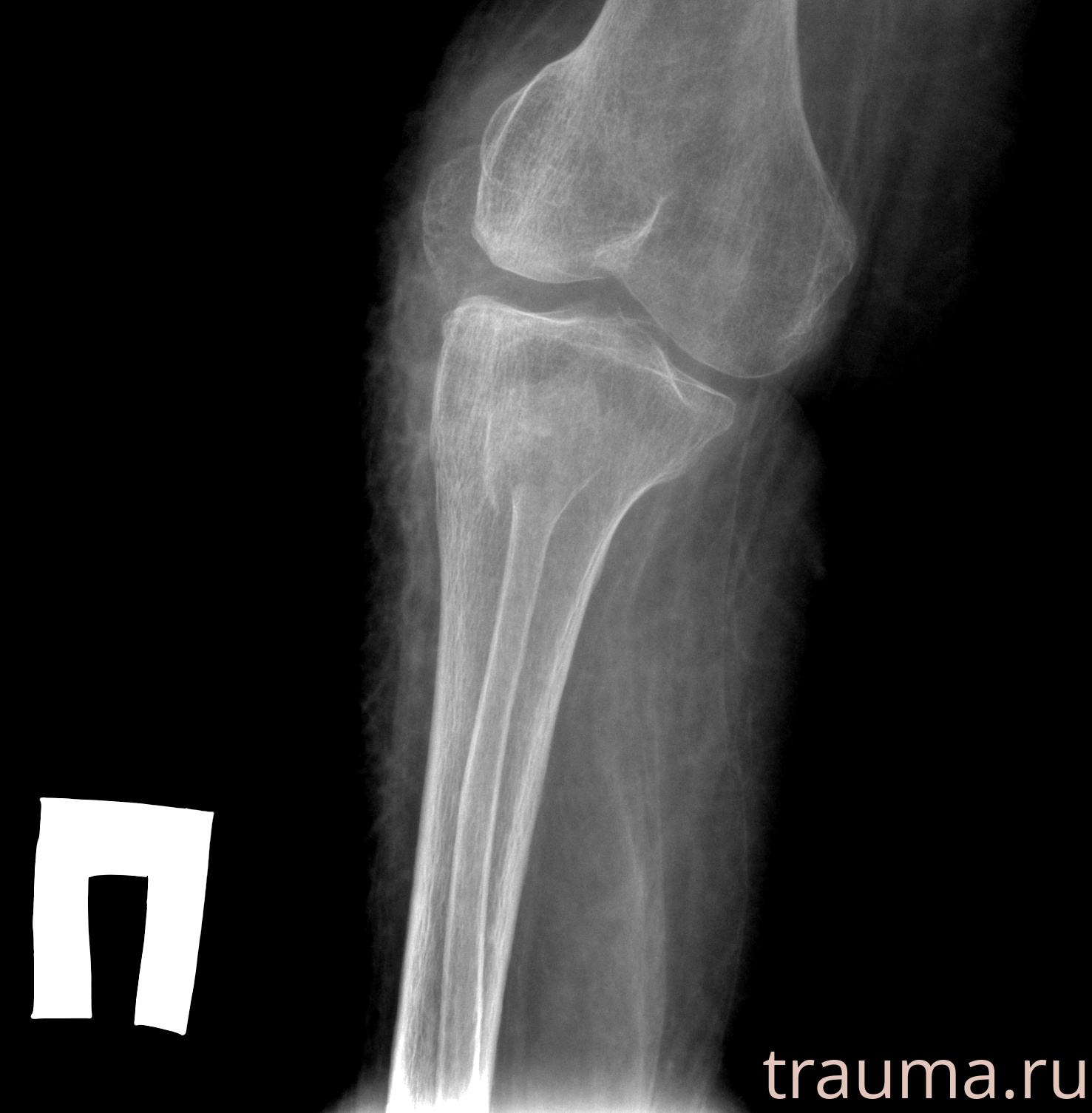 Рентген на дому: по вашему адресу приезжает врач-рентгенолог, травматолог-ортопед с мобильным рентгеновским аппаратом, проводит диагностику травмы или заболевания, делает необходимые рентгенограммы, дает рекомендации по дальнейшему лечению. Получить качественные снимки в домашних условиях возможно благодаря уникальной методике, разработанной МосРентген Центром для института  Склифосовского