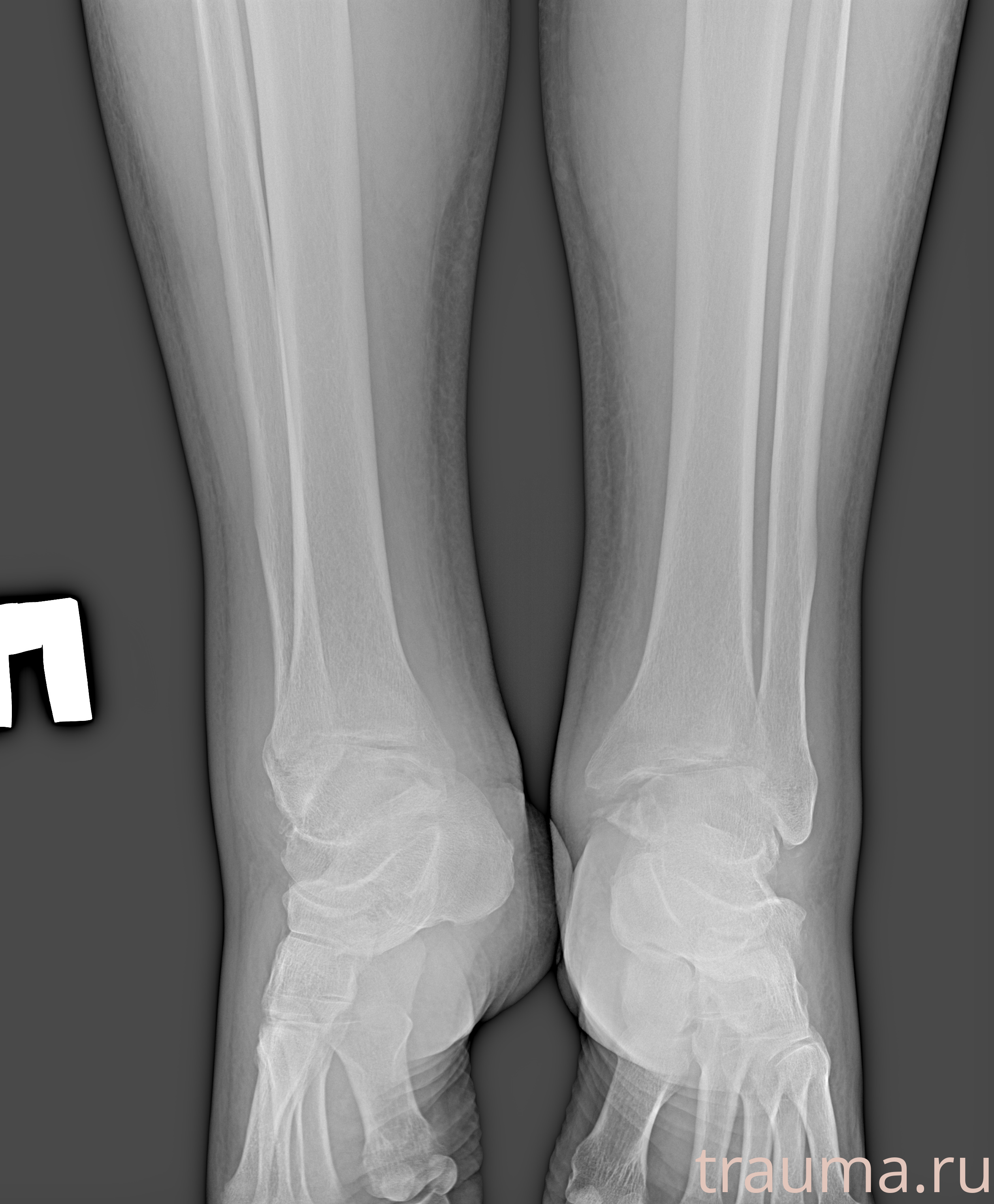 Рентген на дому: по вашему адресу приезжает врач-рентгенолог, травматолог-ортопед с мобильным рентгеновским аппаратом, проводит диагностику травмы или заболевания, делает необходимые рентгенограммы, дает рекомендации по дальнейшему лечению. Получить качественные снимки в домашних условиях возможно благодаря уникальной методике, разработанной МосРентген Центром для института  Склифосовского