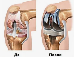 Эндопротезирование в лечении первичных опухолей костей