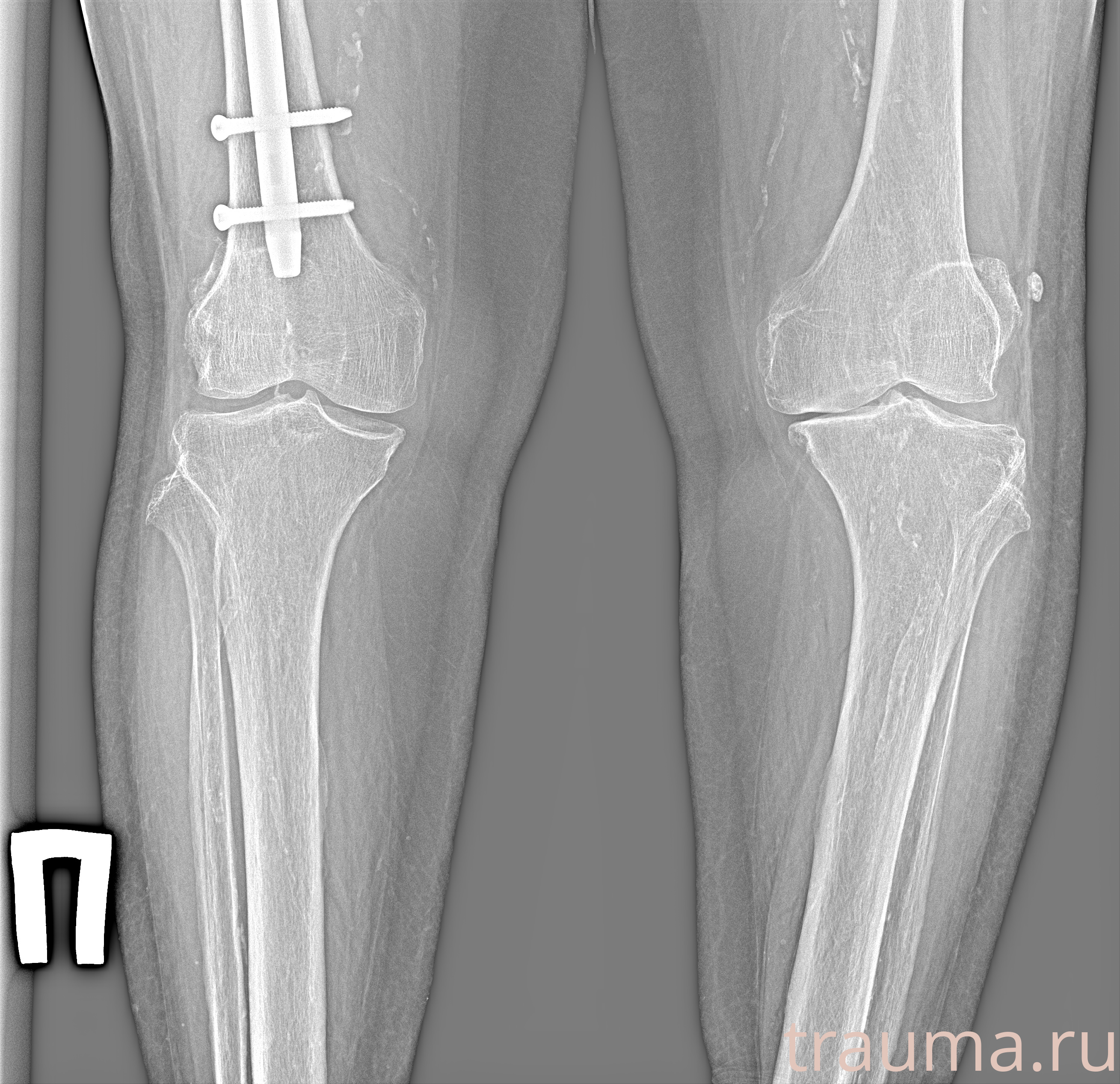 Рентген на дому: по вашему адресу приезжает врач-рентгенолог, травматолог-ортопед с мобильным рентгеновским аппаратом, проводит диагностику травмы или заболевания, делает необходимые рентгенограммы, дает рекомендации по дальнейшему лечению. Получить качественные снимки в домашних условиях возможно благодаря уникальной методике, разработанной МосРентген Центром для института  Склифосовского