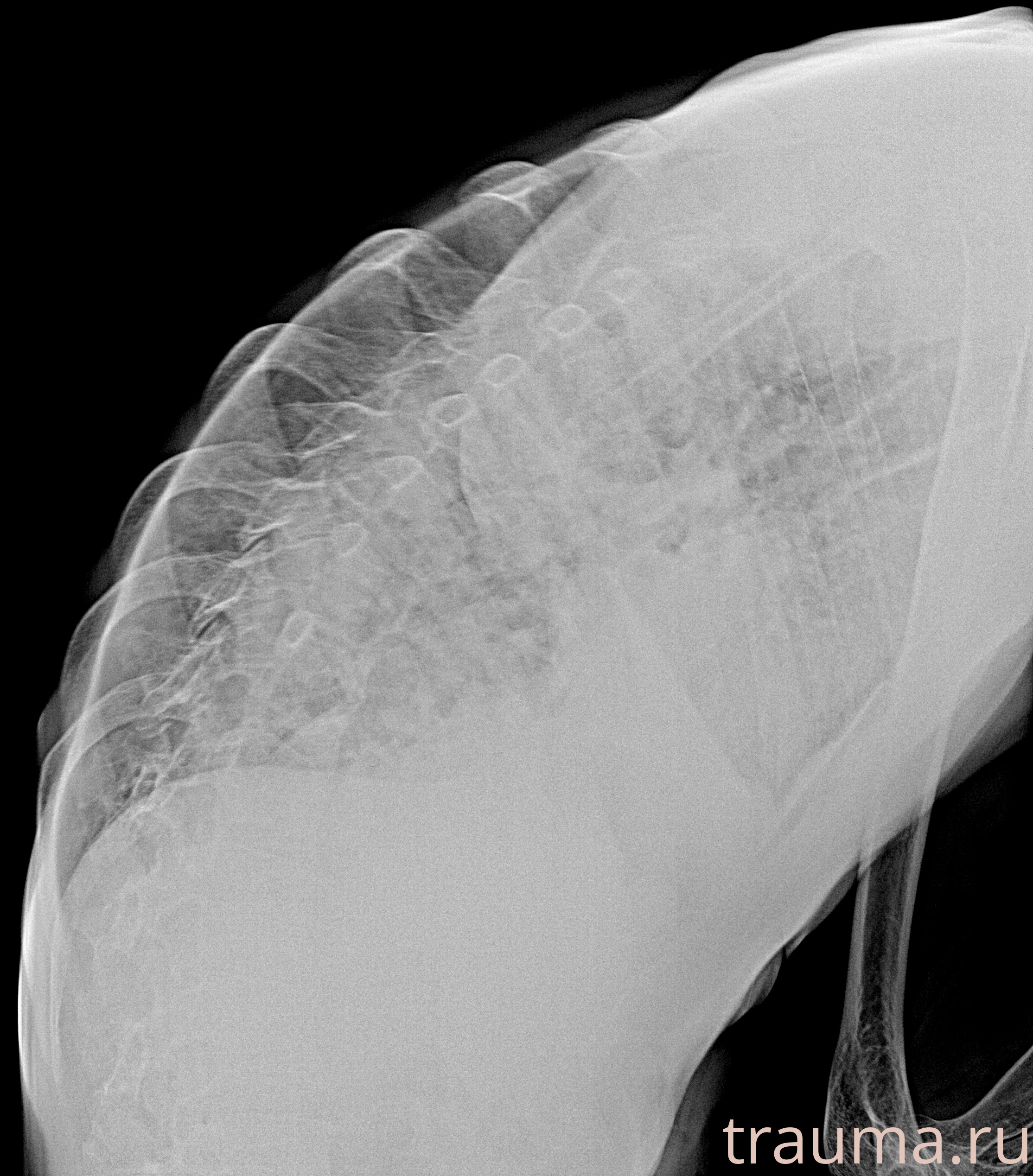 Рентген на дому: по вашему адресу приезжает врач-рентгенолог, травматолог-ортопед с мобильным рентгеновским аппаратом, проводит диагностику травмы или заболевания, делает необходимые рентгенограммы, дает рекомендации по дальнейшему лечению. Получить качественные снимки в домашних условиях возможно благодаря уникальной методике, разработанной МосРентген Центром для института  Склифосовского