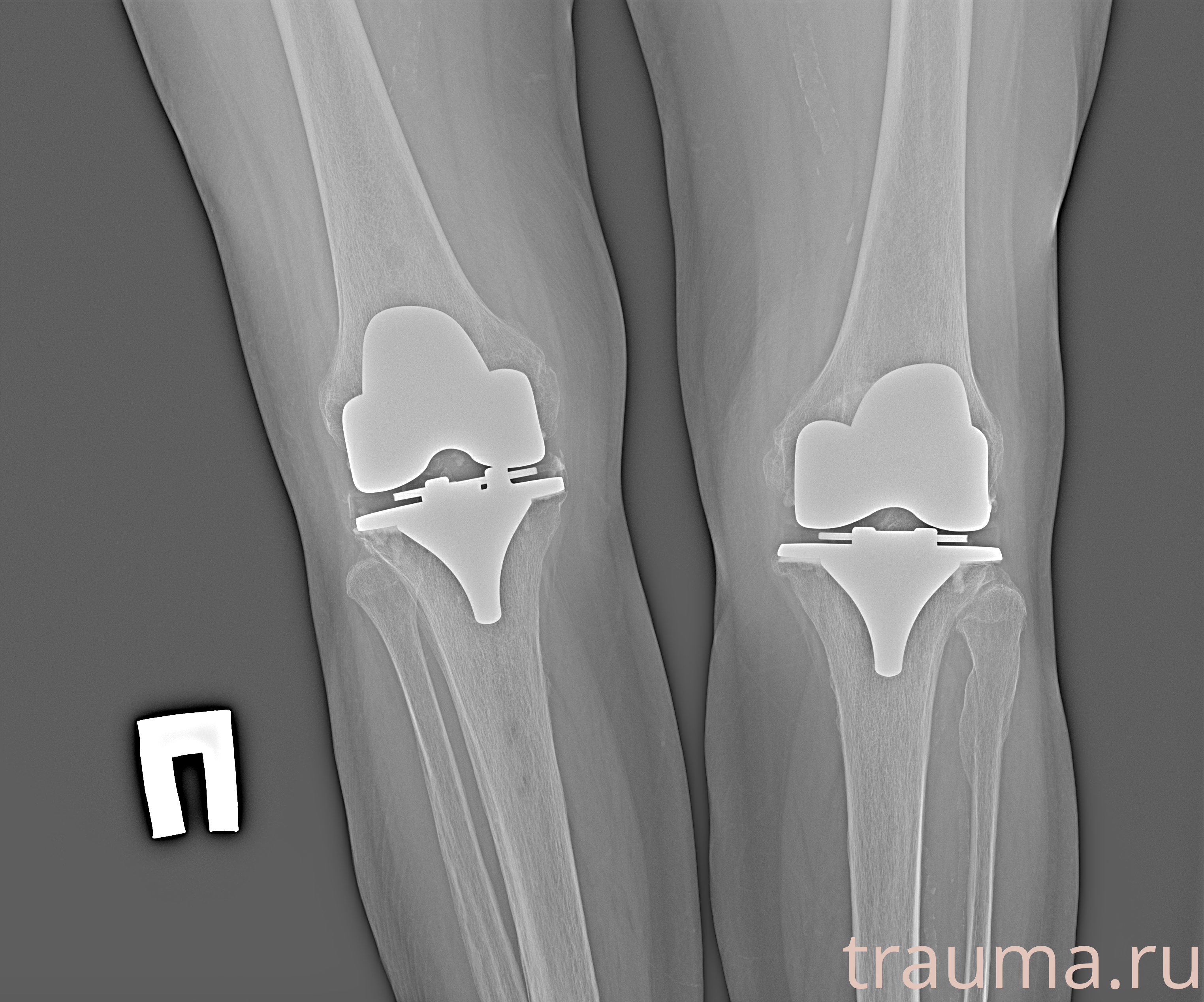 Рентген на дому: по вашему адресу приезжает врач-рентгенолог, травматолог-ортопед с мобильным рентгеновским аппаратом, проводит диагностику травмы или заболевания, делает необходимые рентгенограммы, дает рекомендации по дальнейшему лечению. Получить качественные снимки в домашних условиях возможно благодаря уникальной методике, разработанной МосРентген Центром для института  Склифосовского