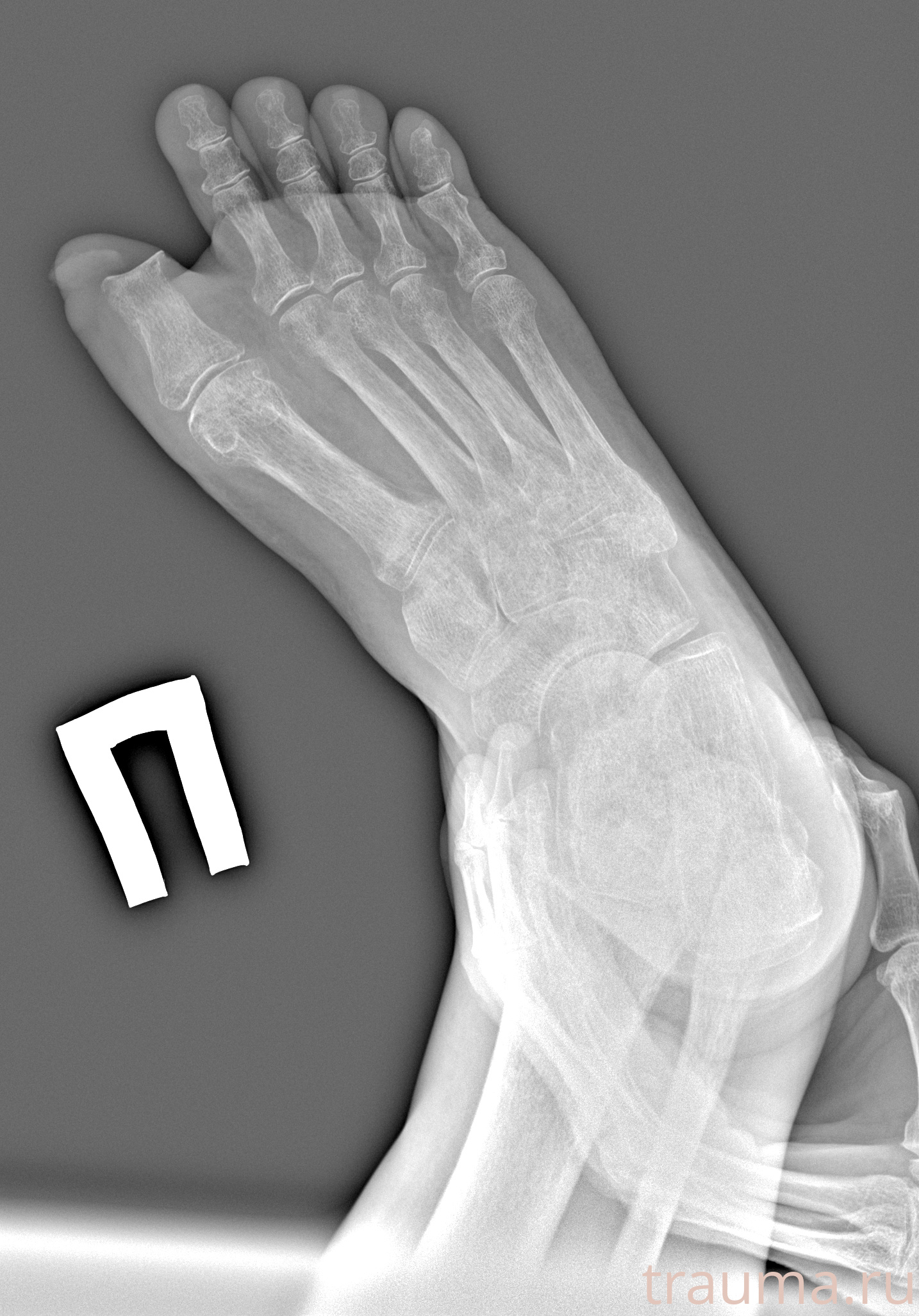 Рентген на дому: по вашему адресу приезжает врач-рентгенолог, травматолог-ортопед с мобильным рентгеновским аппаратом, проводит диагностику травмы или заболевания, делает необходимые рентгенограммы, дает рекомендации по дальнейшему лечению. Получить качественные снимки в домашних условиях возможно благодаря уникальной методике, разработанной МосРентген Центром для института  Склифосовского