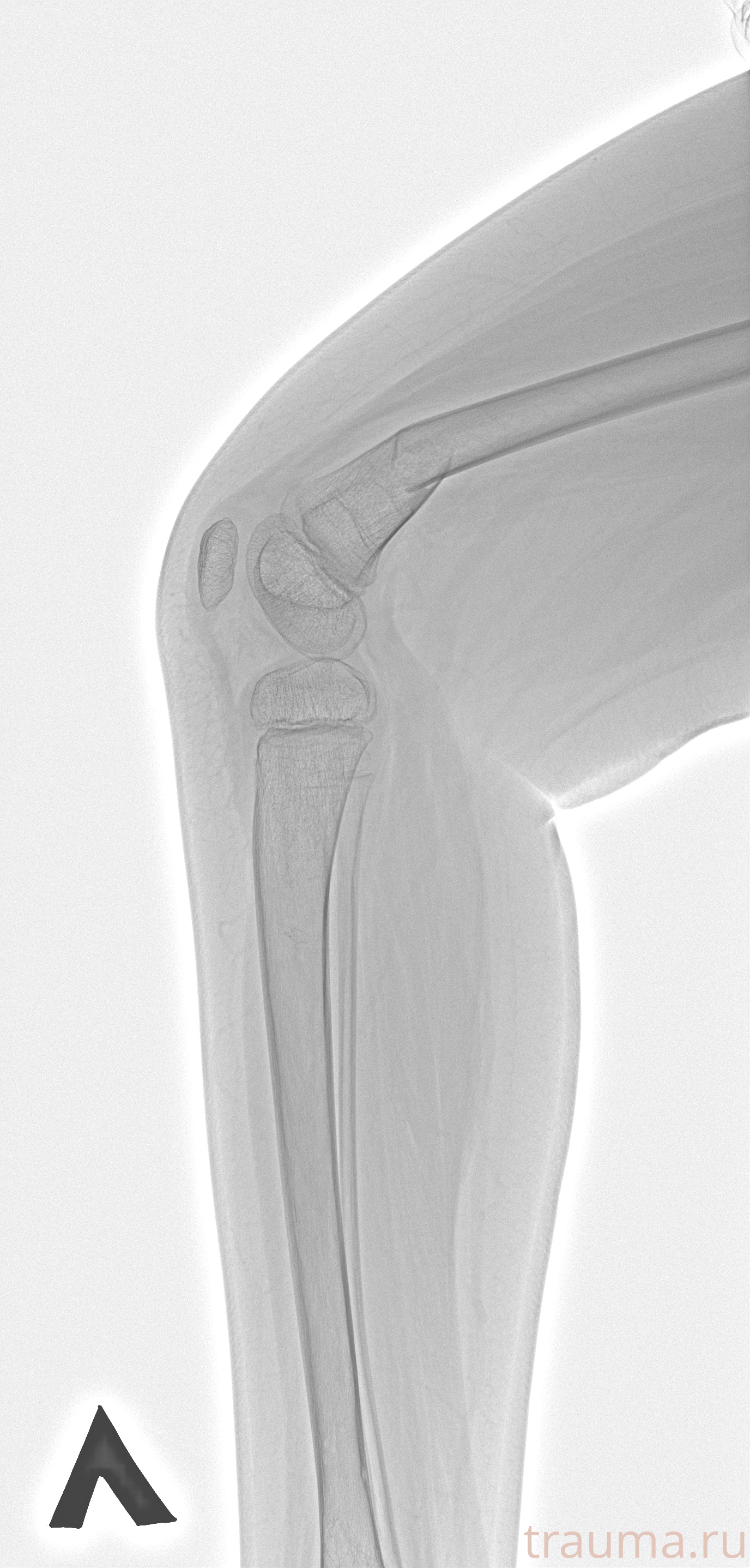 Рентген на дому: по вашему адресу приезжает врач-рентгенолог, травматолог-ортопед с мобильным рентгеновским аппаратом, проводит диагностику травмы или заболевания, делает необходимые рентгенограммы, дает рекомендации по дальнейшему лечению. Получить качественные снимки в домашних условиях возможно благодаря уникальной методике, разработанной МосРентген Центром для института  Склифосовского