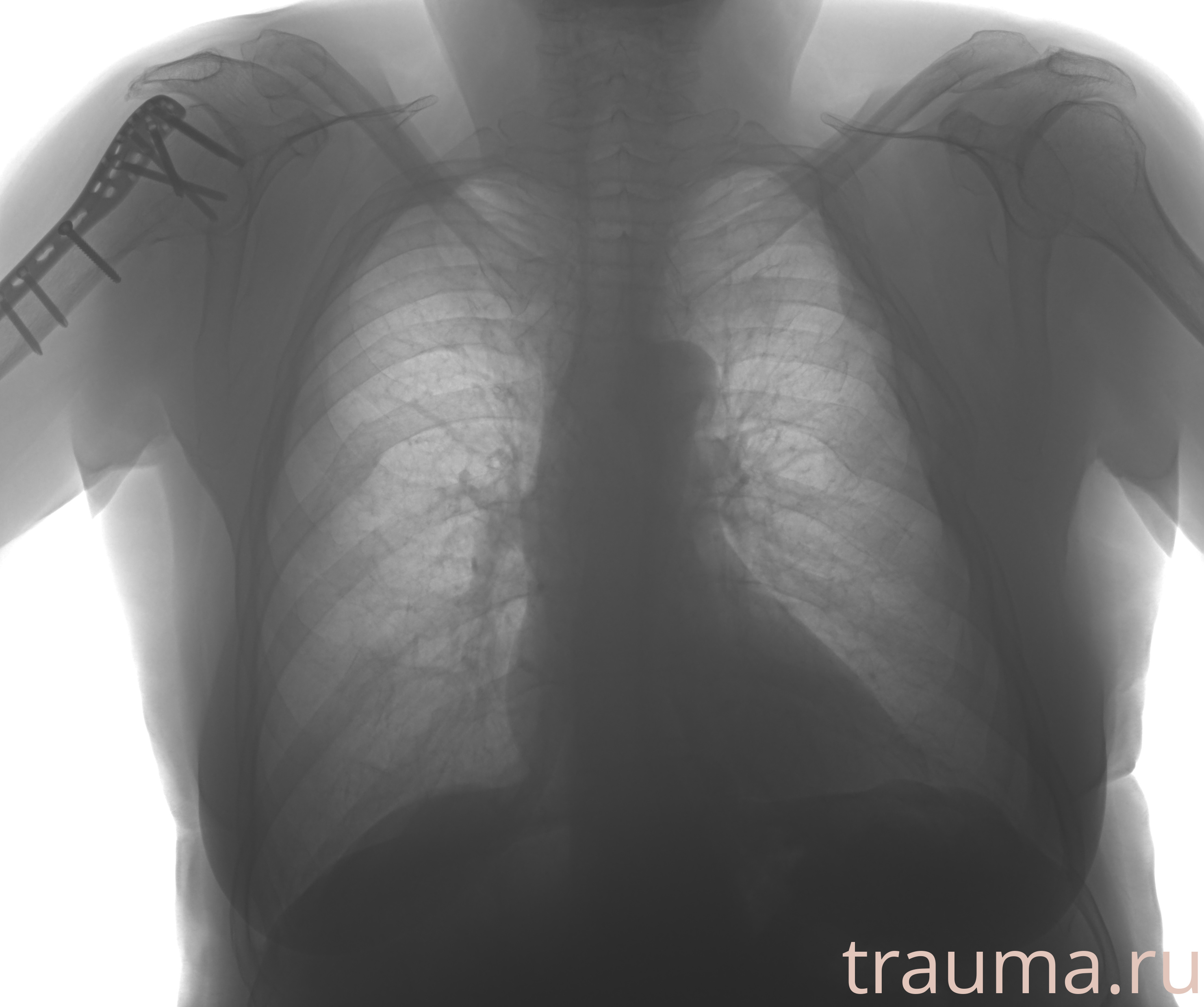 Рентген на дому: по вашему адресу приезжает врач-рентгенолог, травматолог-ортопед с мобильным рентгеновским аппаратом, проводит диагностику травмы или заболевания, делает необходимые рентгенограммы, дает рекомендации по дальнейшему лечению. Получить качественные снимки в домашних условиях возможно благодаря уникальной методике, разработанной МосРентген Центром для института  Склифосовского