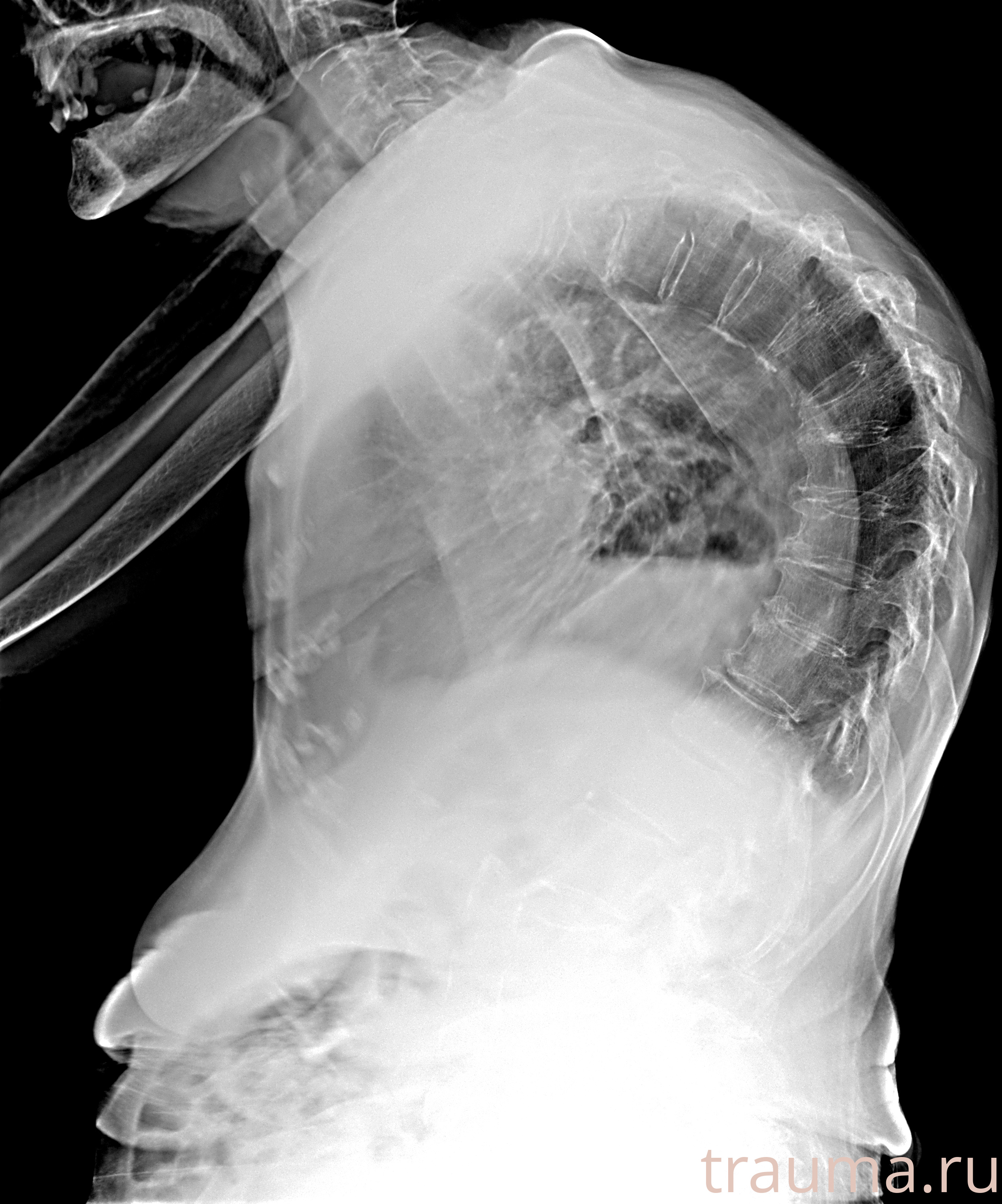 Рентген на дому: по вашему адресу приезжает врач-рентгенолог, травматолог-ортопед с мобильным рентгеновским аппаратом, проводит диагностику травмы или заболевания, делает необходимые рентгенограммы, дает рекомендации по дальнейшему лечению. Получить качественные снимки в домашних условиях возможно благодаря уникальной методике, разработанной МосРентген Центром для института  Склифосовского