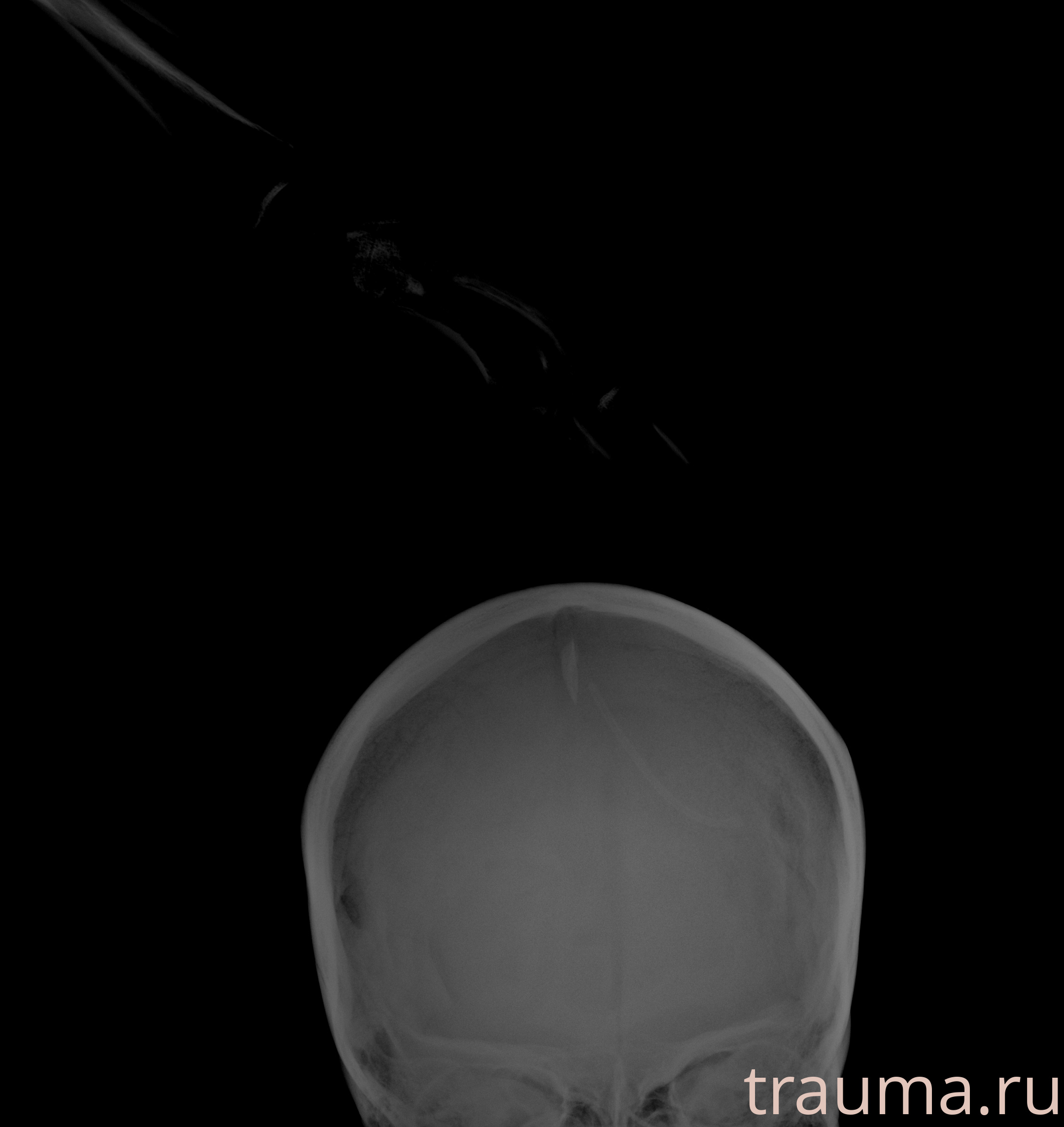 Рентген на дому: по вашему адресу приезжает врач-рентгенолог, травматолог-ортопед с мобильным рентгеновским аппаратом, проводит диагностику травмы или заболевания, делает необходимые рентгенограммы, дает рекомендации по дальнейшему лечению. Получить качественные снимки в домашних условиях возможно благодаря уникальной методике, разработанной МосРентген Центром для института  Склифосовского