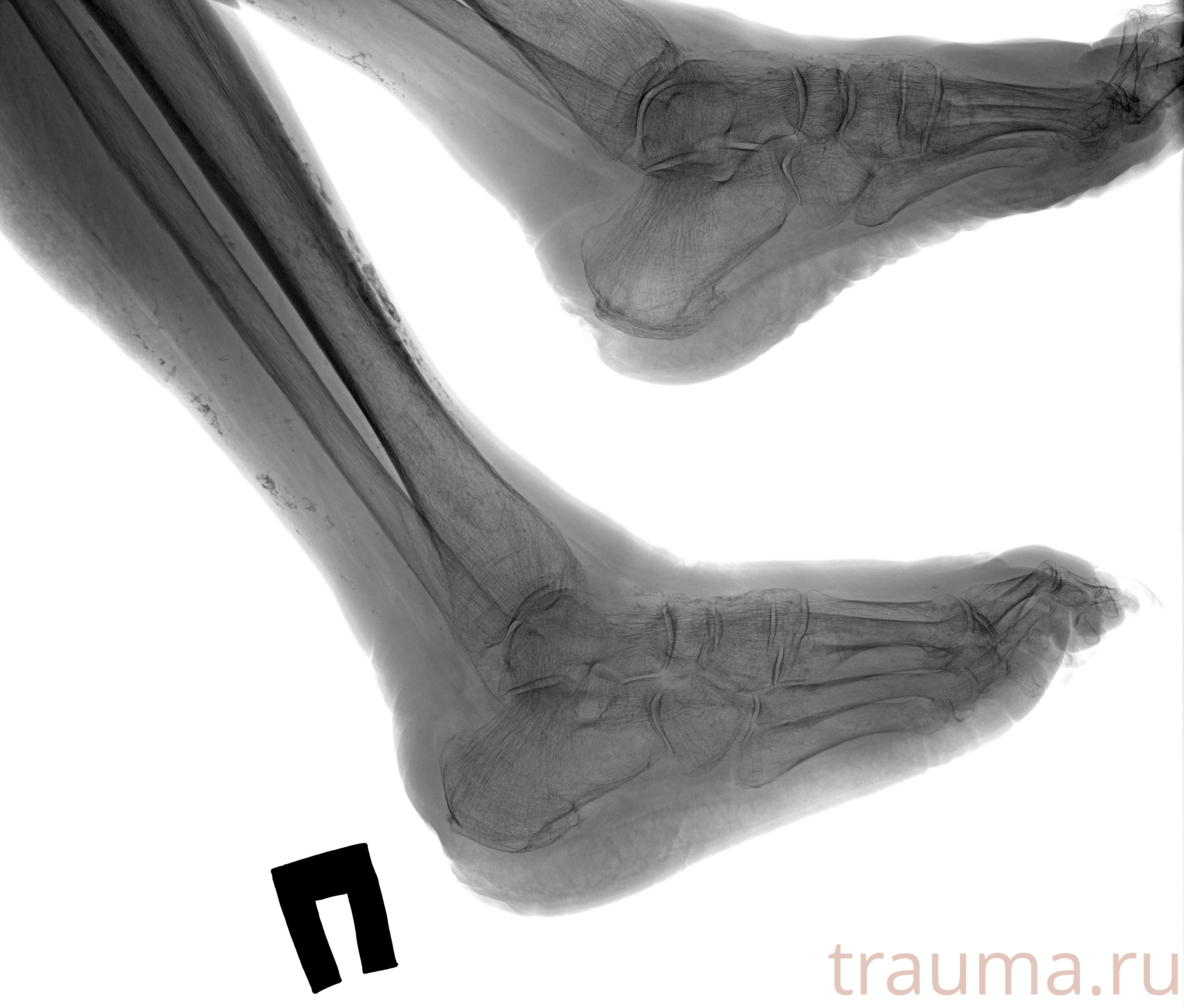 Рентген на дому: по вашему адресу приезжает врач-рентгенолог, травматолог-ортопед с мобильным рентгеновским аппаратом, проводит диагностику травмы или заболевания, делает необходимые рентгенограммы, дает рекомендации по дальнейшему лечению. Получить качественные снимки в домашних условиях возможно благодаря уникальной методике, разработанной МосРентген Центром для института  Склифосовского