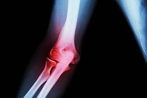 Реабилитация при эндопротезировании коленного сустава