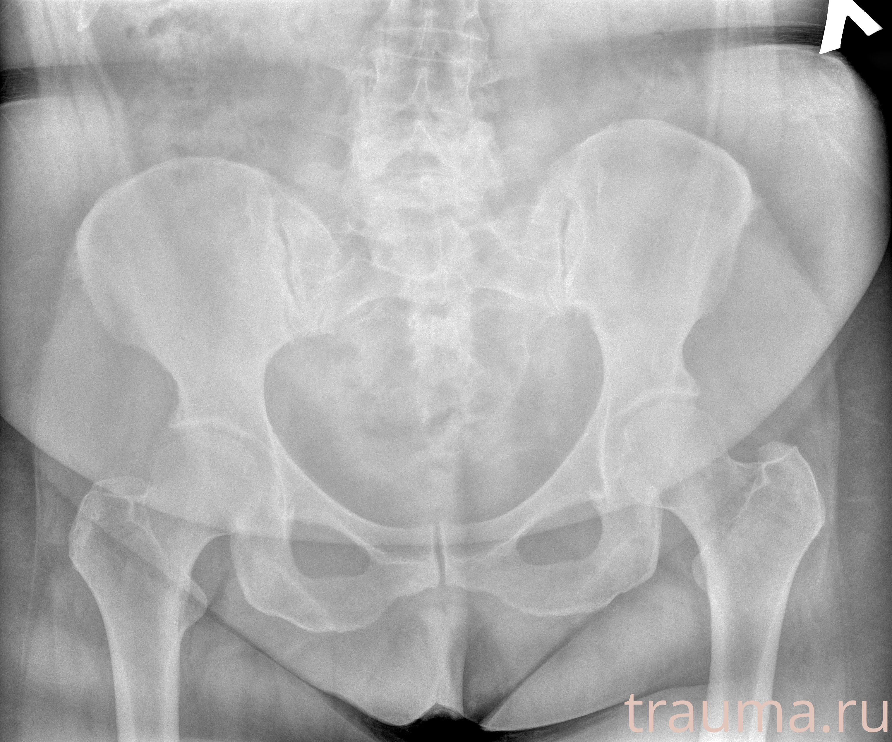 Рентген на дому: по вашему адресу приезжает врач-рентгенолог, травматолог-ортопед с мобильным рентгеновским аппаратом, проводит диагностику травмы или заболевания, делает необходимые рентгенограммы, дает рекомендации по дальнейшему лечению. Получить качественные снимки в домашних условиях возможно благодаря уникальной методике, разработанной МосРентген Центром для института  Склифосовского