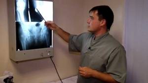 МРТ-диагностика изменений капсульно-связочного аппарата и менисков у больных деформирующим артрозом коленного сустава