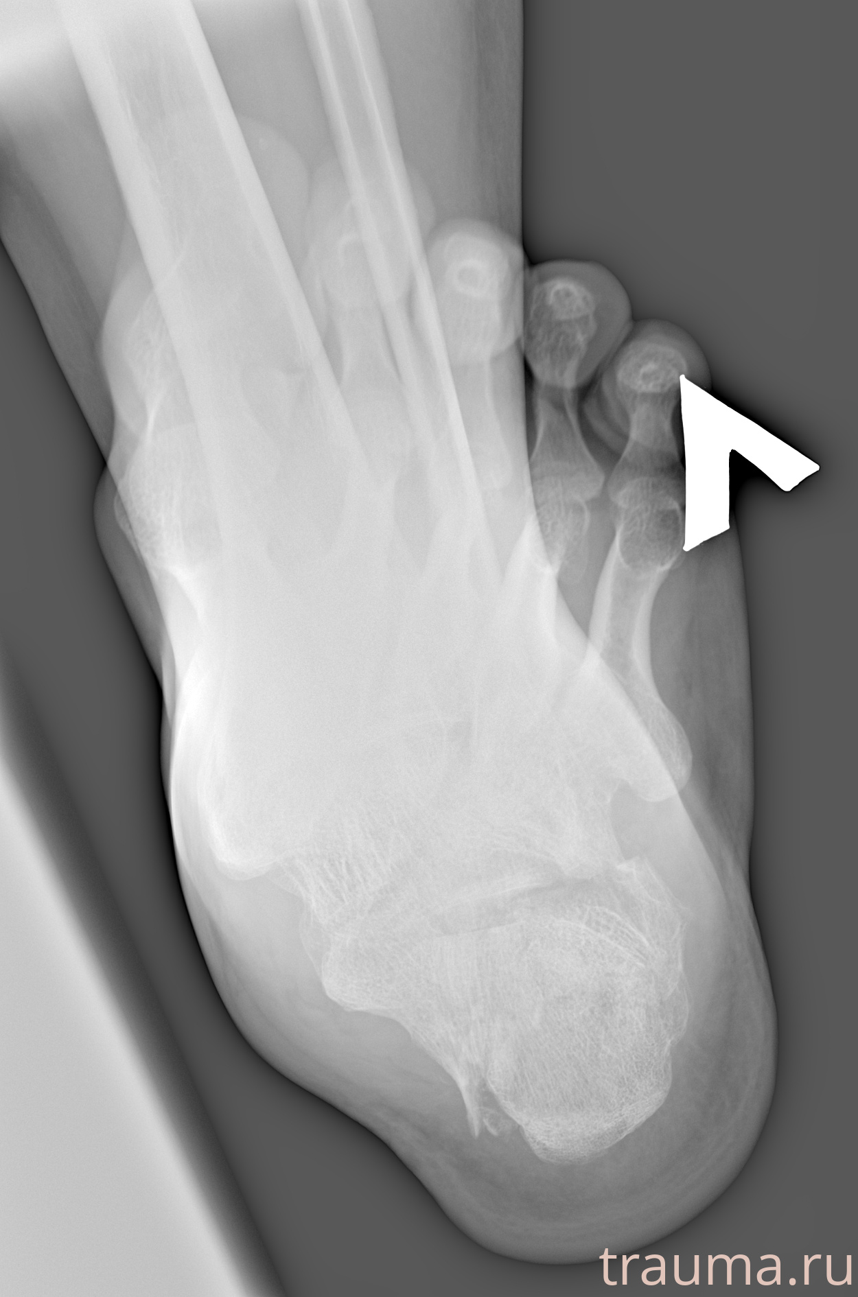 Рентген на дому: по вашему адресу приезжает врач-рентгенолог, травматолог-ортопед с мобильным рентгеновским аппаратом, проводит диагностику травмы или заболевания, делает необходимые рентгенограммы, дает рекомендации по дальнейшему лечению. Получить качественные снимки в домашних условиях возможно благодаря уникальной методике, разработанной МосРентген Центром для института  Склифосовского