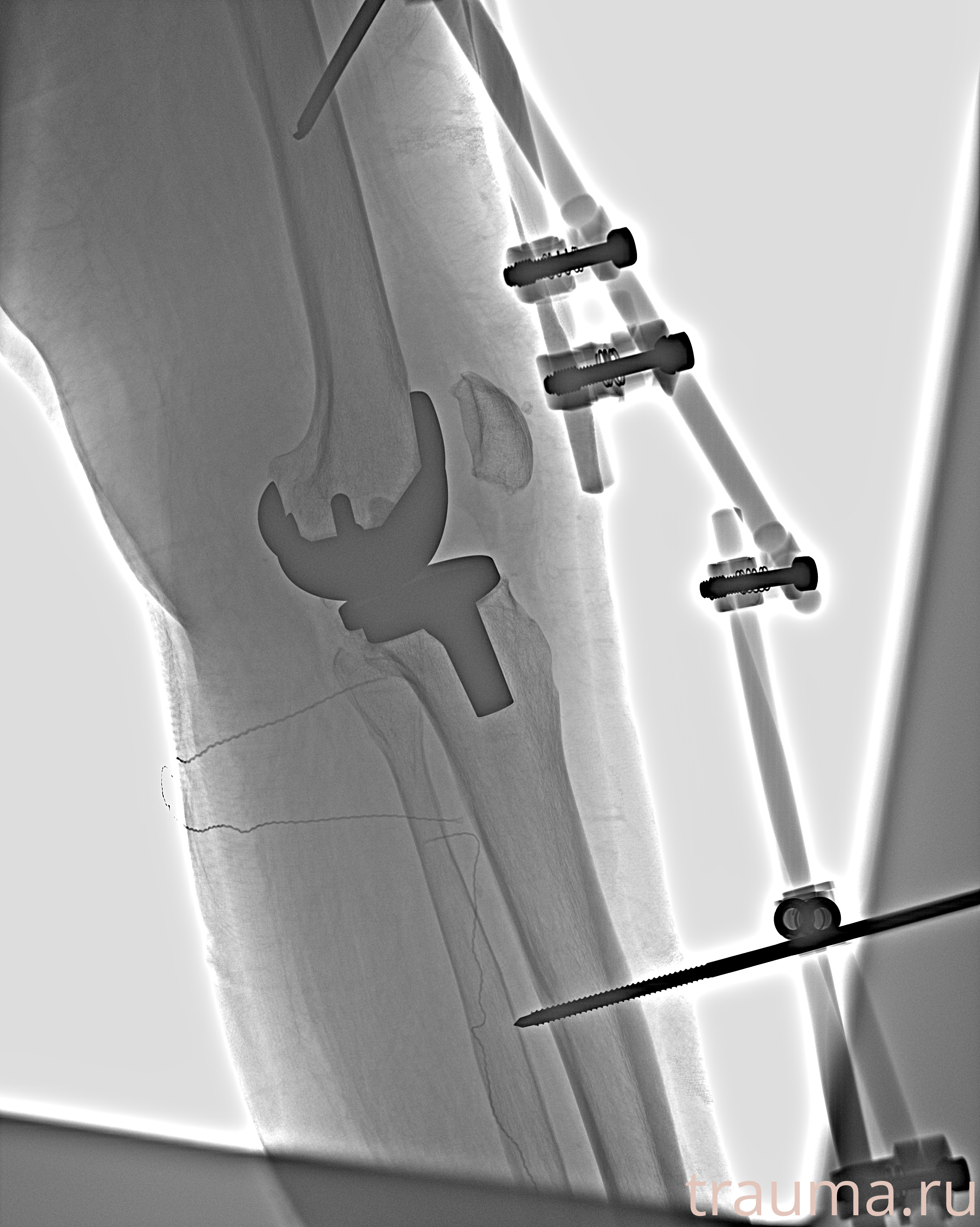 Рентген на дому: по вашему адресу приезжает врач-рентгенолог, травматолог-ортопед с мобильным рентгеновским аппаратом, проводит диагностику травмы или заболевания, делает необходимые рентгенограммы, дает рекомендации по дальнейшему лечению. Получить качественные снимки в домашних условиях возможно благодаря уникальной методике, разработанной МосРентген Центром для института  Склифосовского