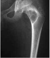 Возможности КТ в диагностике хронического остеомиелита бедренной кости
