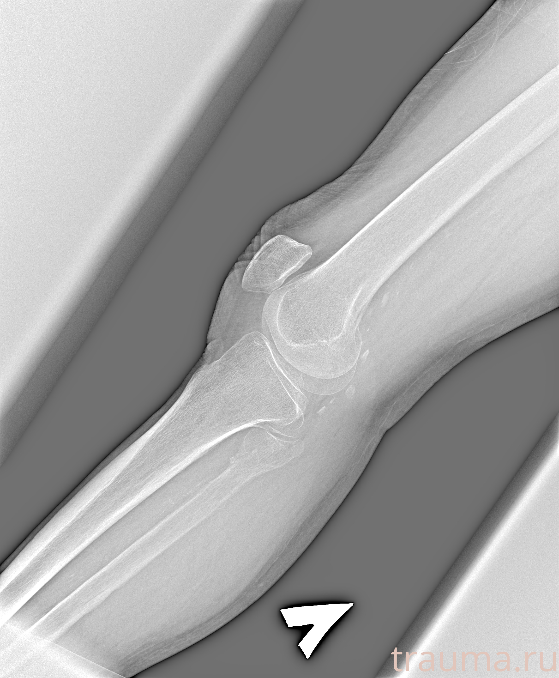 Рентген на дому: по вашему адресу приезжает врач-рентгенолог, травматолог-ортопед с мобильным рентгеновским аппаратом, проводит диагностику травмы или заболевания, делает необходимые рентгенограммы, дает рекомендации по дальнейшему лечению. Получить качественные снимки в домашних условиях возможно благодаря уникальной методике, разработанной МосРентген Центром для института  Склифосовского