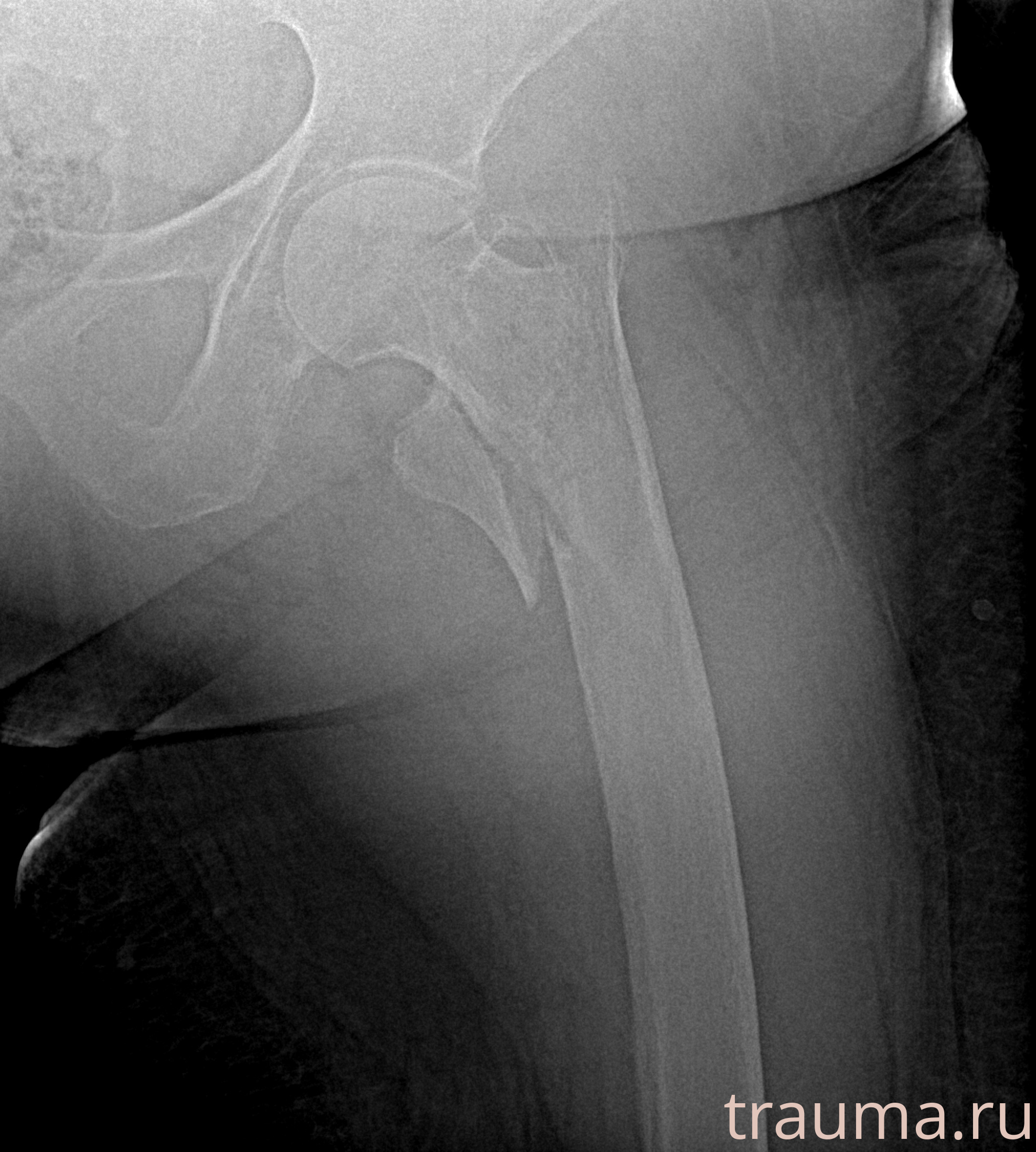 Рентген на дому: по вашему адресу приезжает врач-рентгенолог, травматолог-ортопед с мобильным рентгеновским аппаратом, проводит диагностику травмы или заболевания, делает необходимые рентгенограммы, дает рекомендации по дальнейшему лечению. Получить качественные снимки в домашних условиях возможно благодаря уникальной методике, разработанной МосРентген Центром для института  Склифосовского