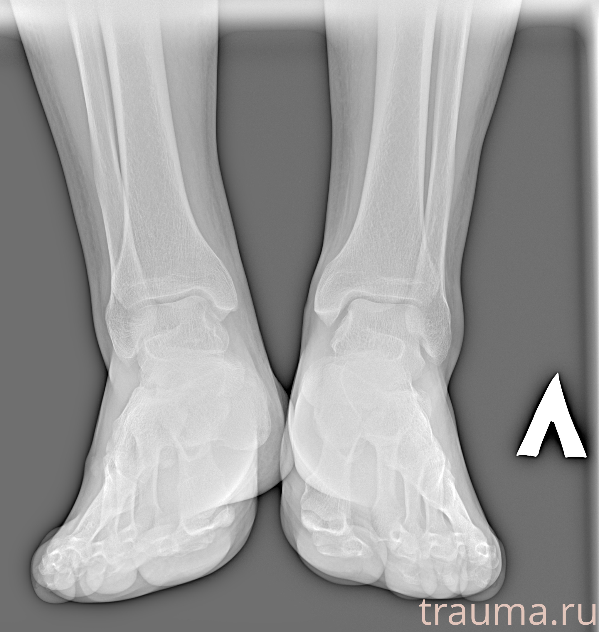 Рентген на дому: по вашему адресу приезжает врач-рентгенолог, травматолог-ортопед с мобильным рентгеновским аппаратом, проводит диагностику травмы или заболевания, делает необходимые рентгенограммы, дает рекомендации по дальнейшему лечению. Получить качественные снимки в домашних условиях возможно благодаря уникальной методике, разработанной МосРентген Центром для института  Склифосовского