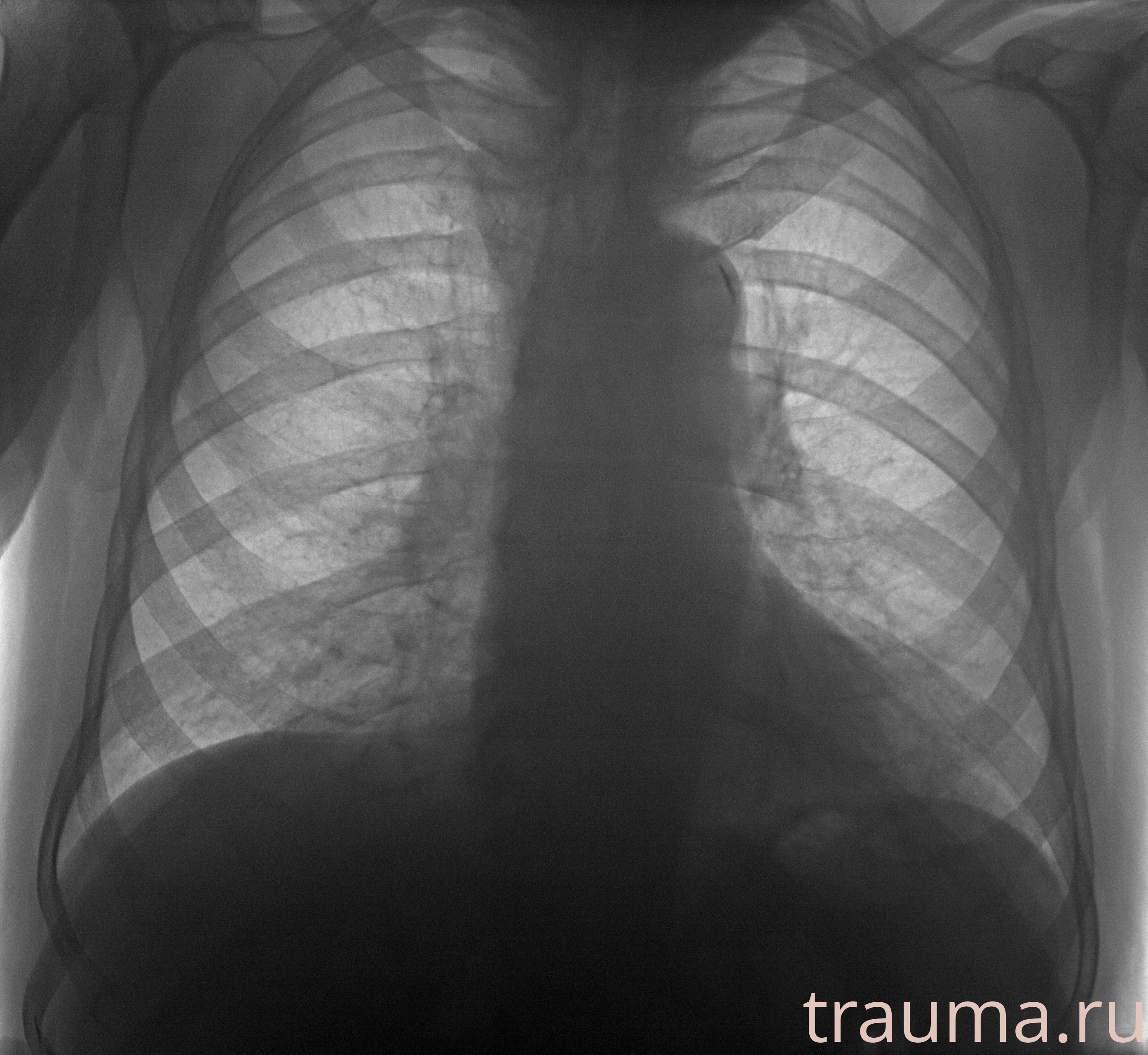 Рентген на дому: по вашему адресу приезжает врач-рентгенолог, травматолог-ортопед с мобильным рентгеновским аппаратом, проводит диагностику травмы или заболевания, делает необходимые рентгенограммы, дает рекомендации по дальнейшему лечению. Получить качественные снимки в домашних условиях возможно благодаря уникальной методике, разработанной МосРентген Центром для института  Склифосовского