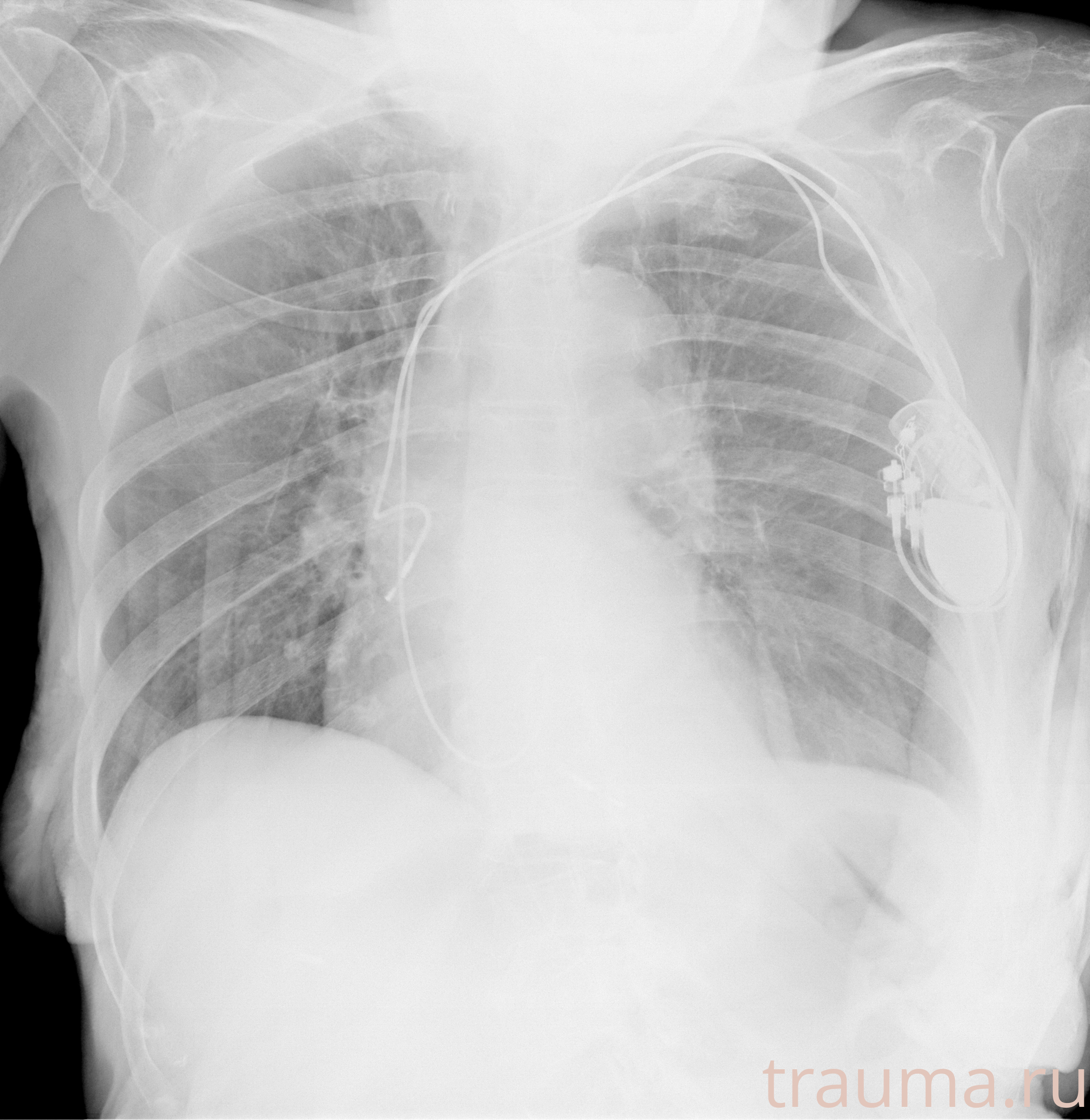 Рентген на дому: по вашему адресу приезжает врач-рентгенолог, травматолог-ортопед с мобильным рентгеновским аппаратом, проводит диагностику травмы или заболевания, делает необходимые рентгенограммы, дает рекомендации по дальнейшему лечению. Получить качественные снимки в домашних условиях возможно благодаря уникальной методике, разработанной МосРентген Центром для института  Склифосовского