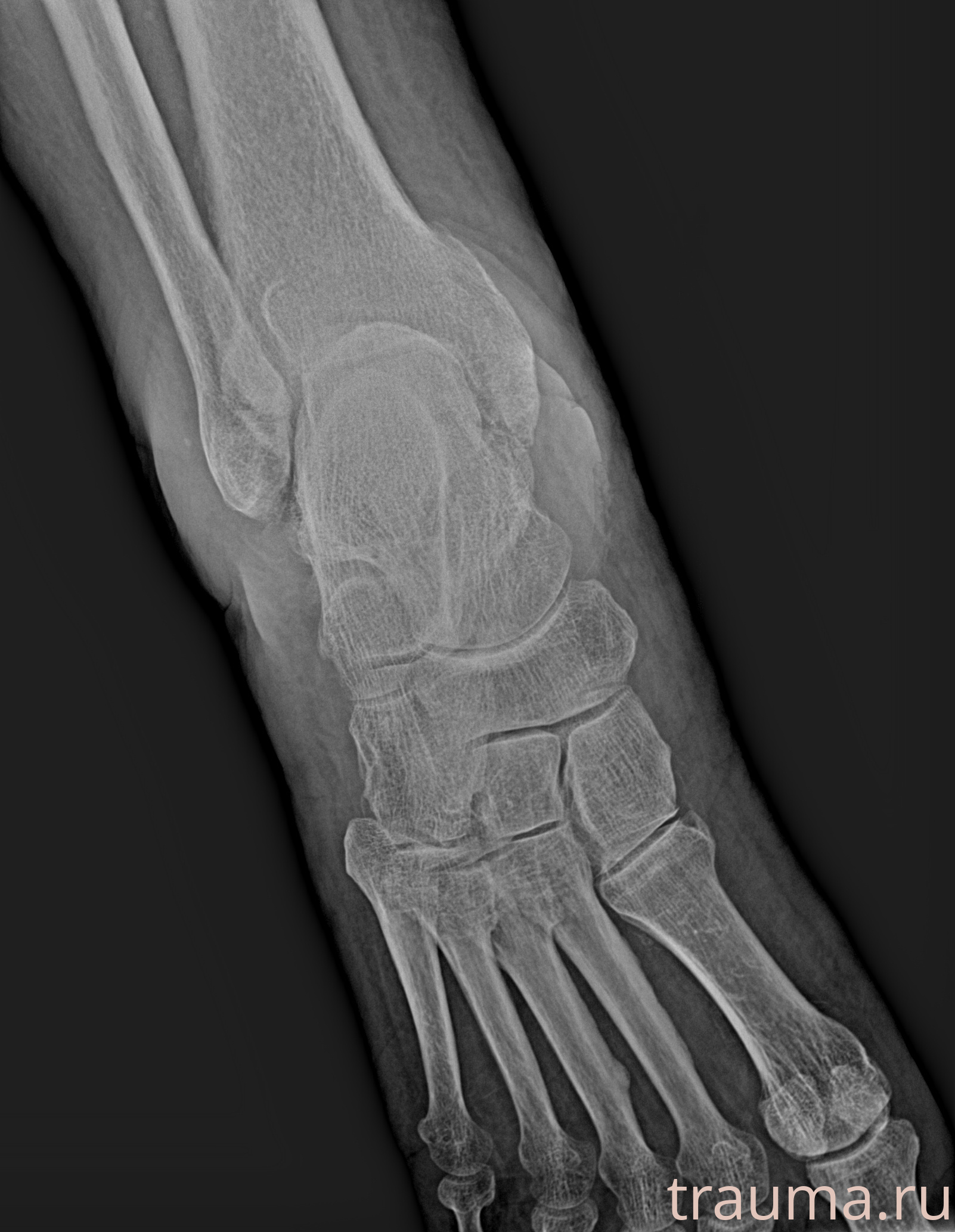 Рентген на дому: по вашему адресу приезжает врач-рентгенолог, травматолог-ортопед с мобильным рентгеновским аппаратом, проводит диагностику травмы или заболевания, делает необходимые рентгенограммы, дает рекомендации по дальнейшему лечению. Получить качественные снимки в домашних условиях возможно благодаря уникальной методике, разработанной МосРентген Центром для института  Склифосовского