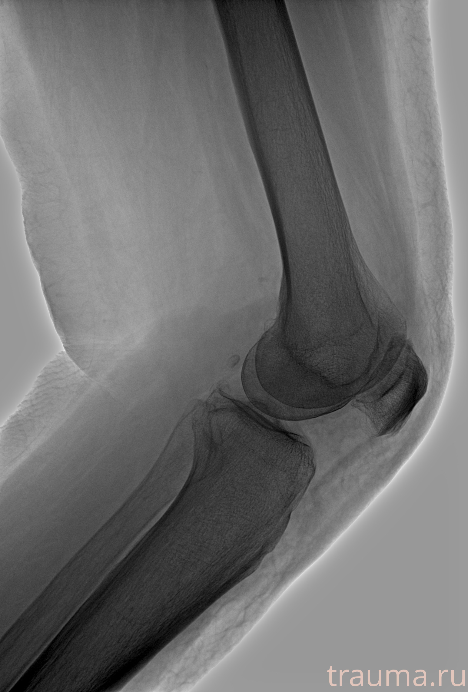 Рентген на дому: по вашему адресу приезжает врач-рентгенолог, травматолог-ортопед с мобильным рентгеновским аппаратом, проводит диагностику травмы или заболевания, делает необходимые рентгенограммы, дает рекомендации по дальнейшему лечению. Получить качественные снимки в домашних условиях возможно благодаря уникальной методике, разработанной МосРентген Центром для института  Склифосовского