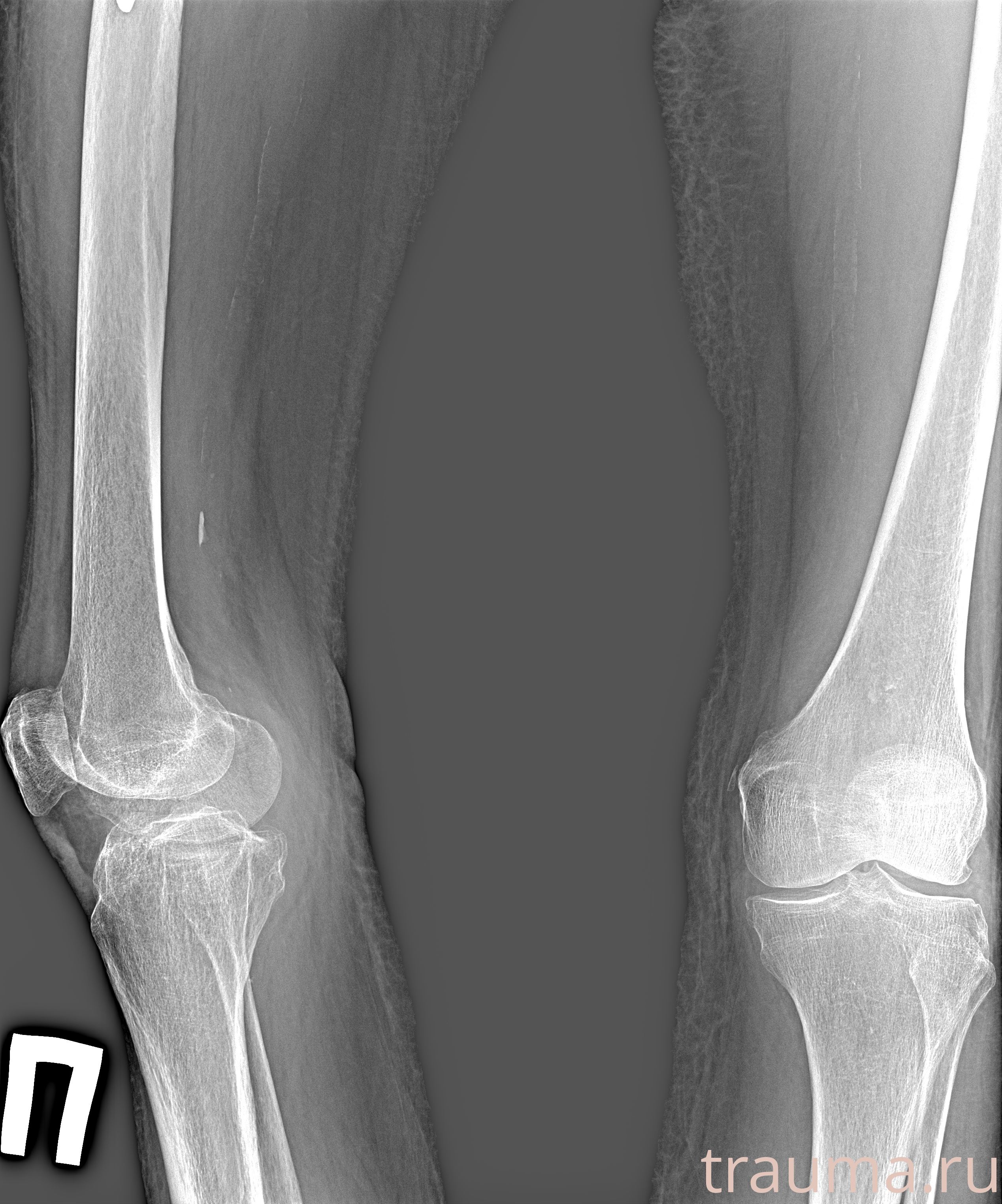 Рентген на дому: по вашему адресу приезжает врач-рентгенолог, травматолог-ортопед с мобильным рентгеновским аппаратом, проводит диагностику травмы или заболевания, делает необходимые рентгенограммы, дает рекомендации по дальнейшему лечению. Получить качественные снимки в домашних условиях возможно благодаря уникальной методике, разработанной МосРентген Центром для института  Склифосовского