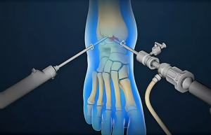 Артроскопия голеностопного сустава: современная малоинвазивная диагностика и лечение дегенеративно-дистрофических заболеваний