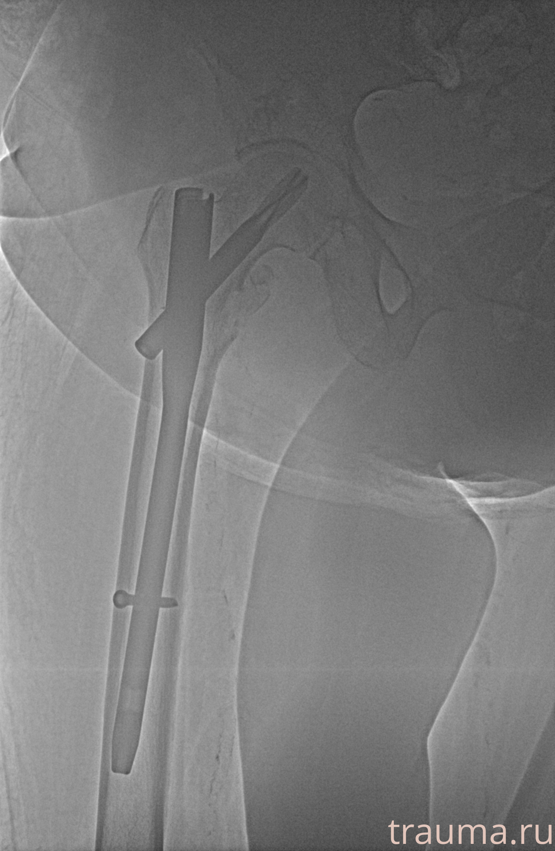 Рентген на дому: по вашему адресу приезжает врач-рентгенолог, травматолог-ортопед с мобильным рентгеновским аппаратом, проводит диагностику травмы или заболевания, делает необходимые рентгенограммы, дает рекомендации по дальнейшему лечению. Получить качественные снимки в домашних условиях возможно благодаря уникальной методике, разработанной МосРентген Центром для института  Склифосовского