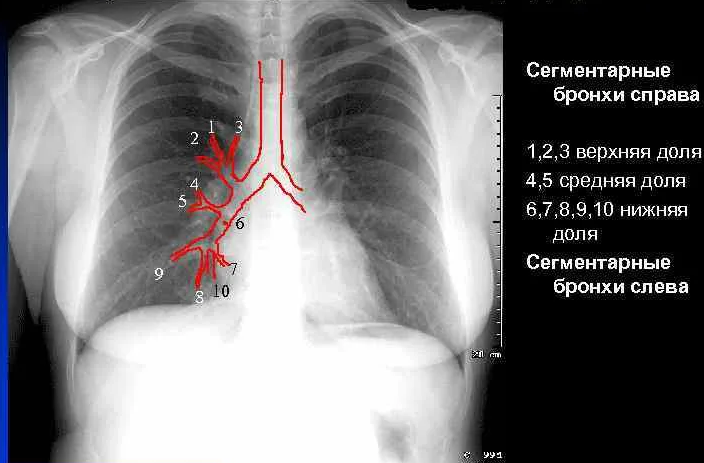 Рентген легких схема