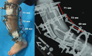 Сравнительный анализ коррекции многовершинных деформаций костей голени при помощи различных методик использования ортопедических гексаподов