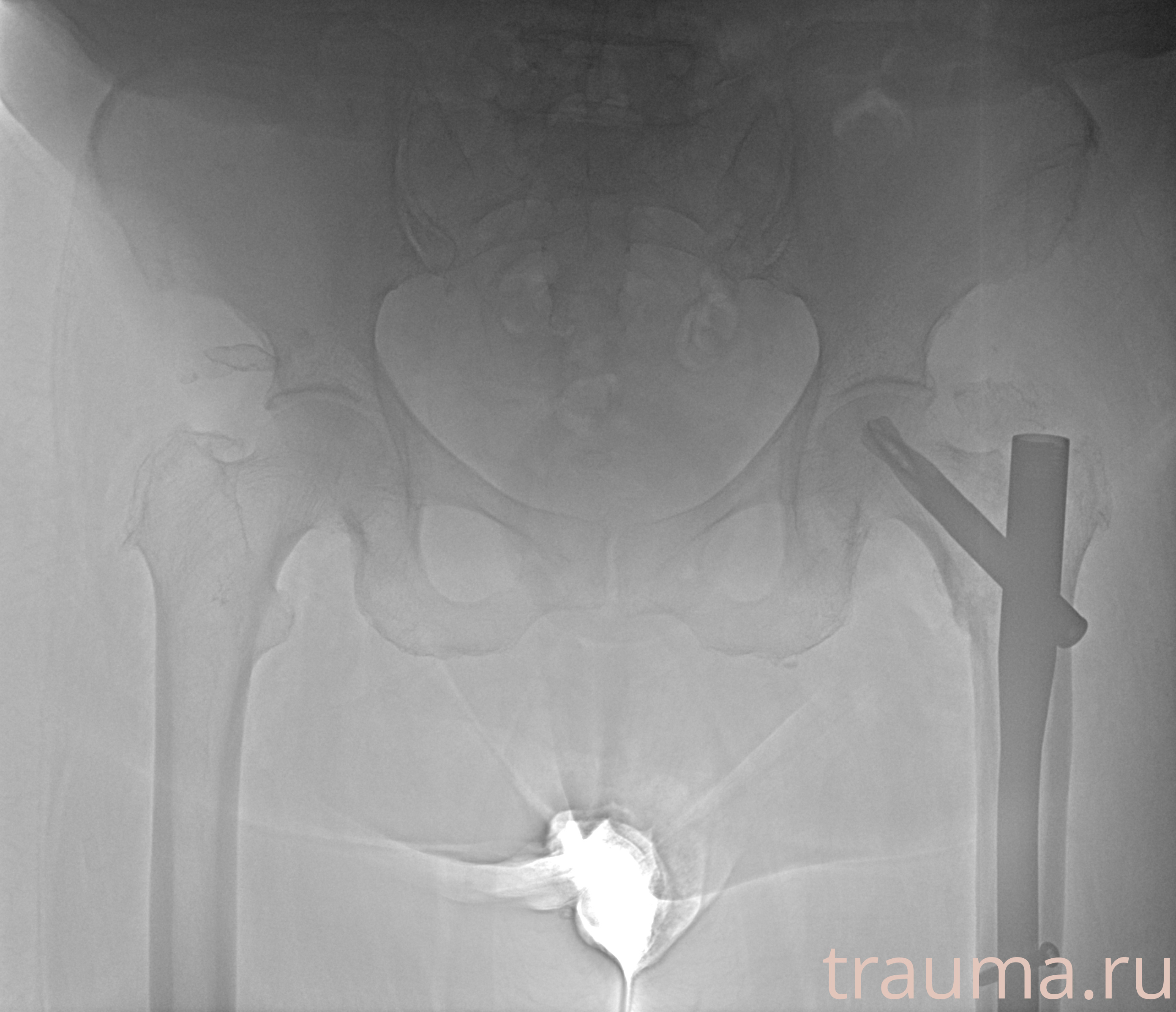 Рентген на дому: по вашему адресу приезжает врач-рентгенолог, травматолог-ортопед с мобильным рентгеновским аппаратом, проводит диагностику травмы или заболевания, делает необходимые рентгенограммы, дает рекомендации по дальнейшему лечению. Получить качественные снимки в домашних условиях возможно благодаря уникальной методике, разработанной МосРентген Центром для института  Склифосовского