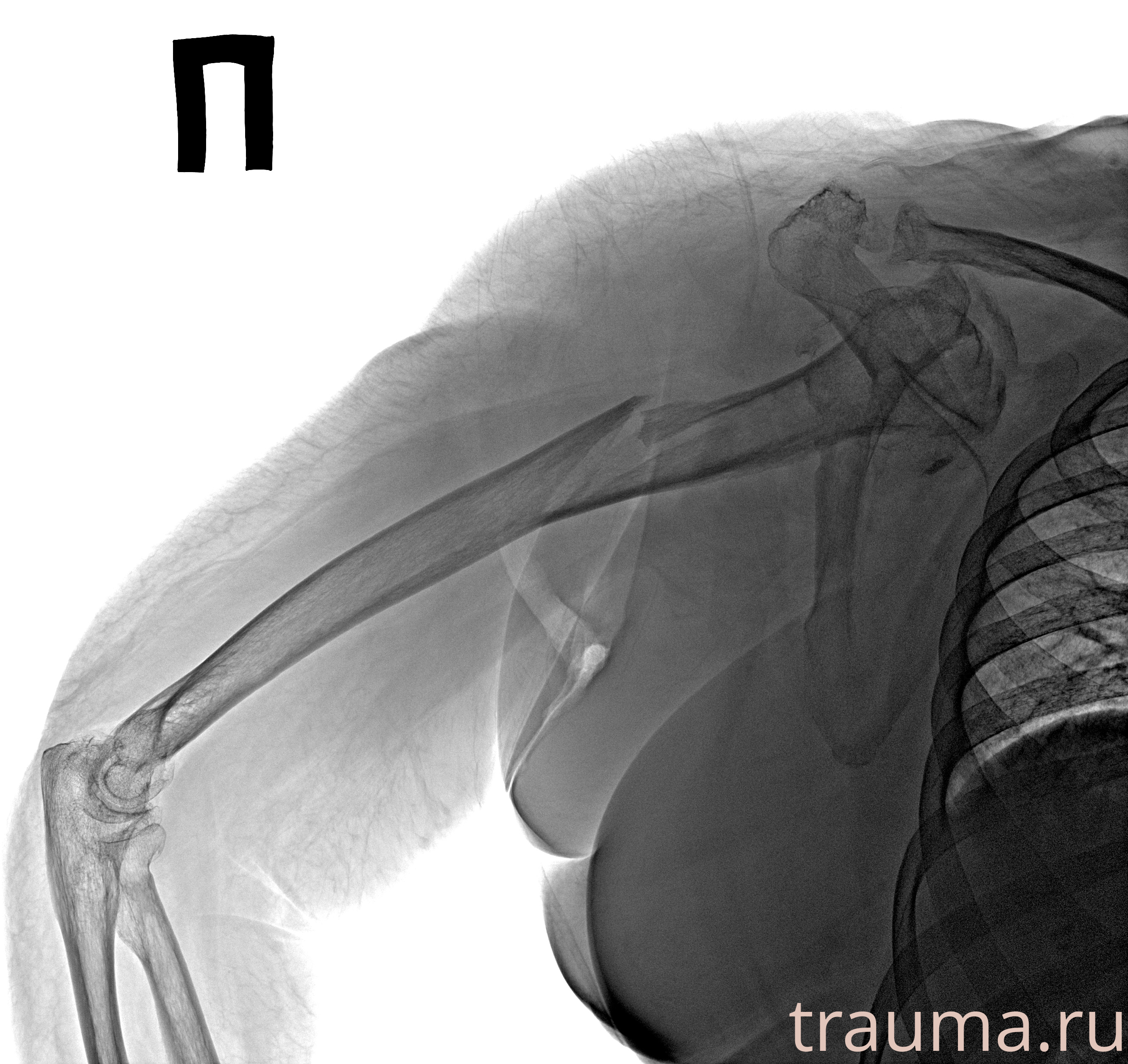 Рентген на дому: по вашему адресу приезжает врач-рентгенолог, травматолог-ортопед с мобильным рентгеновским аппаратом, проводит диагностику травмы или заболевания, делает необходимые рентгенограммы, дает рекомендации по дальнейшему лечению. Получить качественные снимки в домашних условиях возможно благодаря уникальной методике, разработанной МосРентген Центром для института  Склифосовского