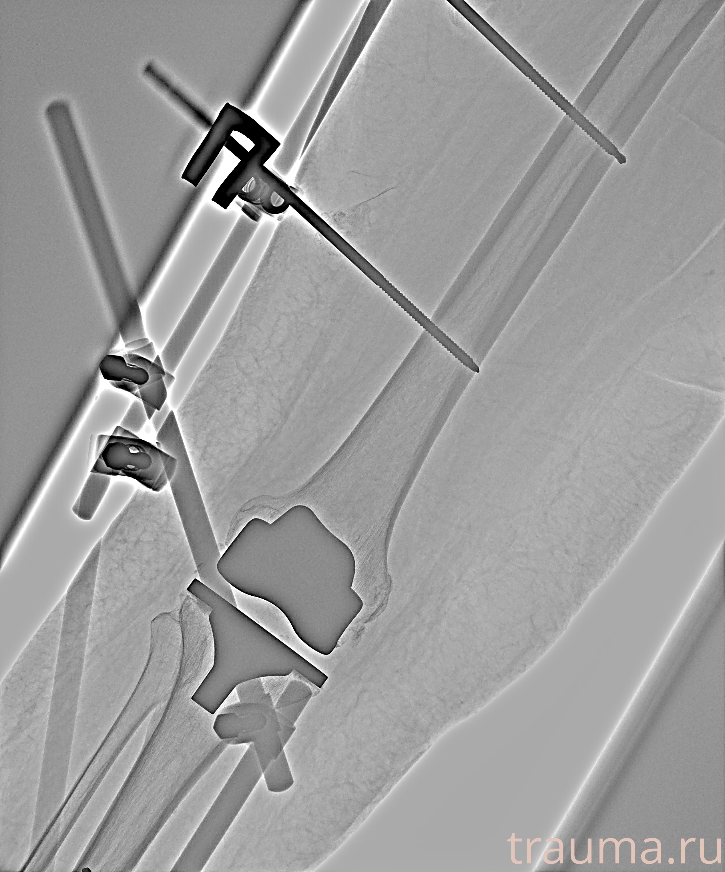 Рентген на дому: по вашему адресу приезжает врач-рентгенолог, травматолог-ортопед с мобильным рентгеновским аппаратом, проводит диагностику травмы или заболевания, делает необходимые рентгенограммы, дает рекомендации по дальнейшему лечению. Получить качественные снимки в домашних условиях возможно благодаря уникальной методике, разработанной МосРентген Центром для института  Склифосовского