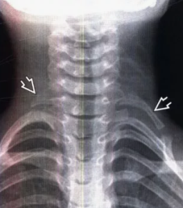 Хирургическое лечение синдрома грудного выхода