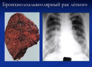 Дифференциальная рентгенодиагностика заболеваний органов дыхания и средостения(часть 11)