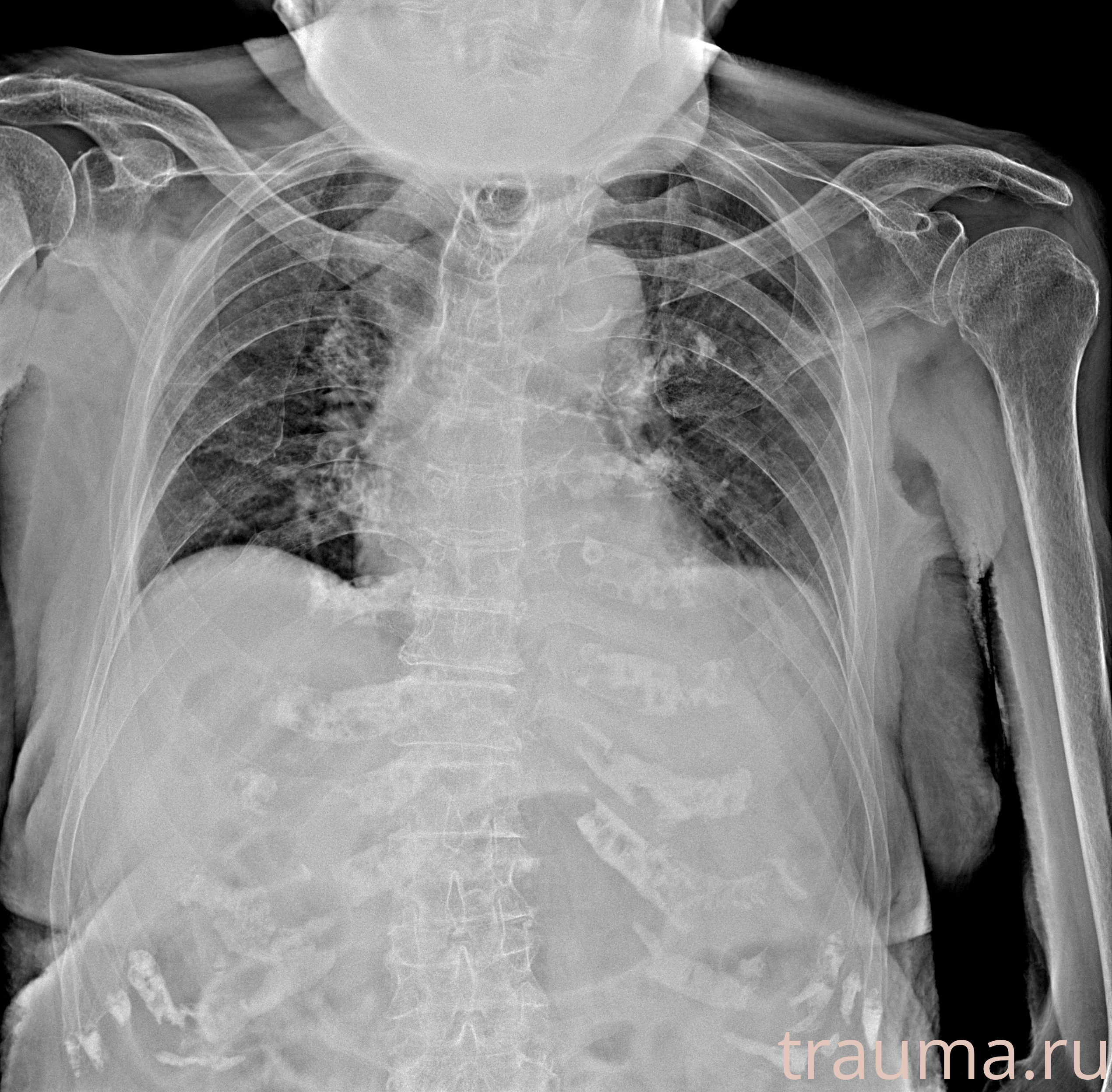 Рентген на дому: по вашему адресу приезжает врач-рентгенолог, травматолог-ортопед с мобильным рентгеновским аппаратом, проводит диагностику травмы или заболевания, делает необходимые рентгенограммы, дает рекомендации по дальнейшему лечению. Получить качественные снимки в домашних условиях возможно благодаря уникальной методике, разработанной МосРентген Центром для института  Склифосовского