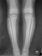 Возможности КТ области коленных суставов в диагностике и оценке результатов лечения болезни Эрлахера-Блаунта