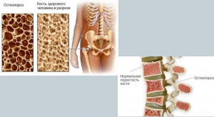 Минеральная плотность костной ткани у больных с диабетическими поражениями нижних конечностей (обзор литературы)