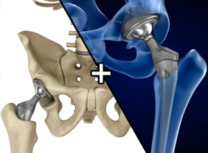 Применение индивидуального импланта при ревизионном эндопротезировании тазобедренного сустава с костным дефектом типа IV по Paprosky
