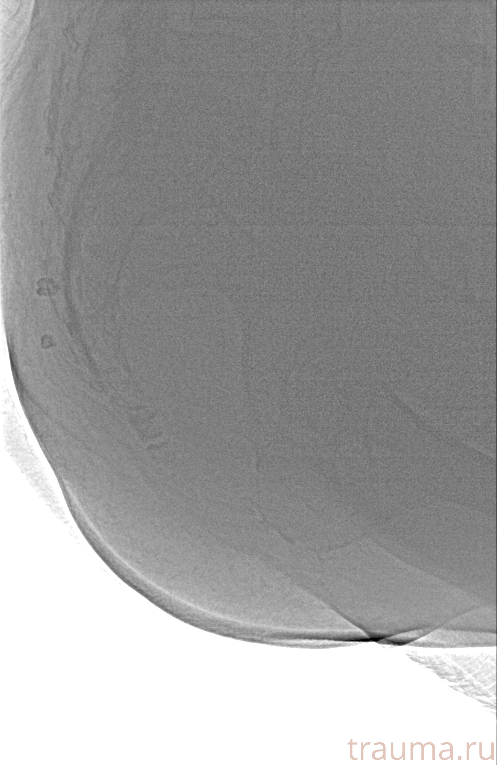 Рентген на дому: по вашему адресу приезжает врач-рентгенолог, травматолог-ортопед с мобильным рентгеновским аппаратом, проводит диагностику травмы или заболевания, делает необходимые рентгенограммы, дает рекомендации по дальнейшему лечению. Получить качественные снимки в домашних условиях возможно благодаря уникальной методике, разработанной МосРентген Центром для института  Склифосовского