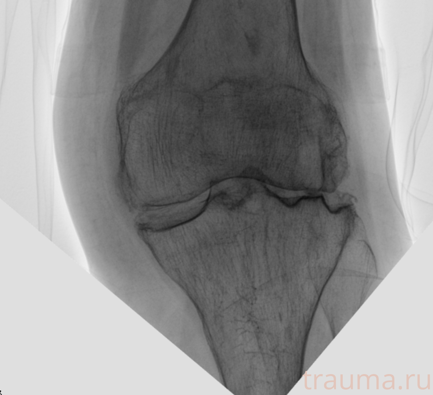 Рентген на дому: по вашему адресу приезжает врач-рентгенолог, травматолог-ортопед с мобильным рентгеновским аппаратом, проводит диагностику травмы или заболевания, делает необходимые рентгенограммы, дает рекомендации по дальнейшему лечению. Получить качественные снимки в домашних условиях возможно благодаря уникальной методике, разработанной МосРентген Центром для института  Склифосовского