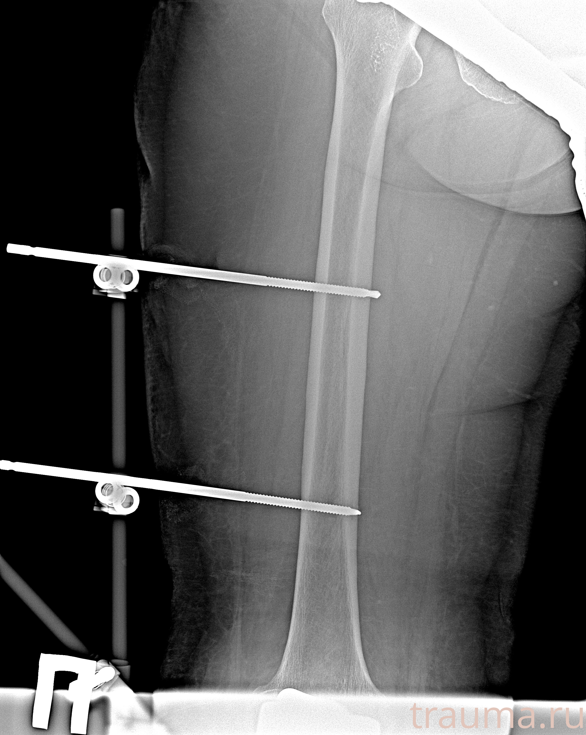 Рентген на дому: по вашему адресу приезжает врач-рентгенолог, травматолог-ортопед с мобильным рентгеновским аппаратом, проводит диагностику травмы или заболевания, делает необходимые рентгенограммы, дает рекомендации по дальнейшему лечению. Получить качественные снимки в домашних условиях возможно благодаря уникальной методике, разработанной МосРентген Центром для института  Склифосовского