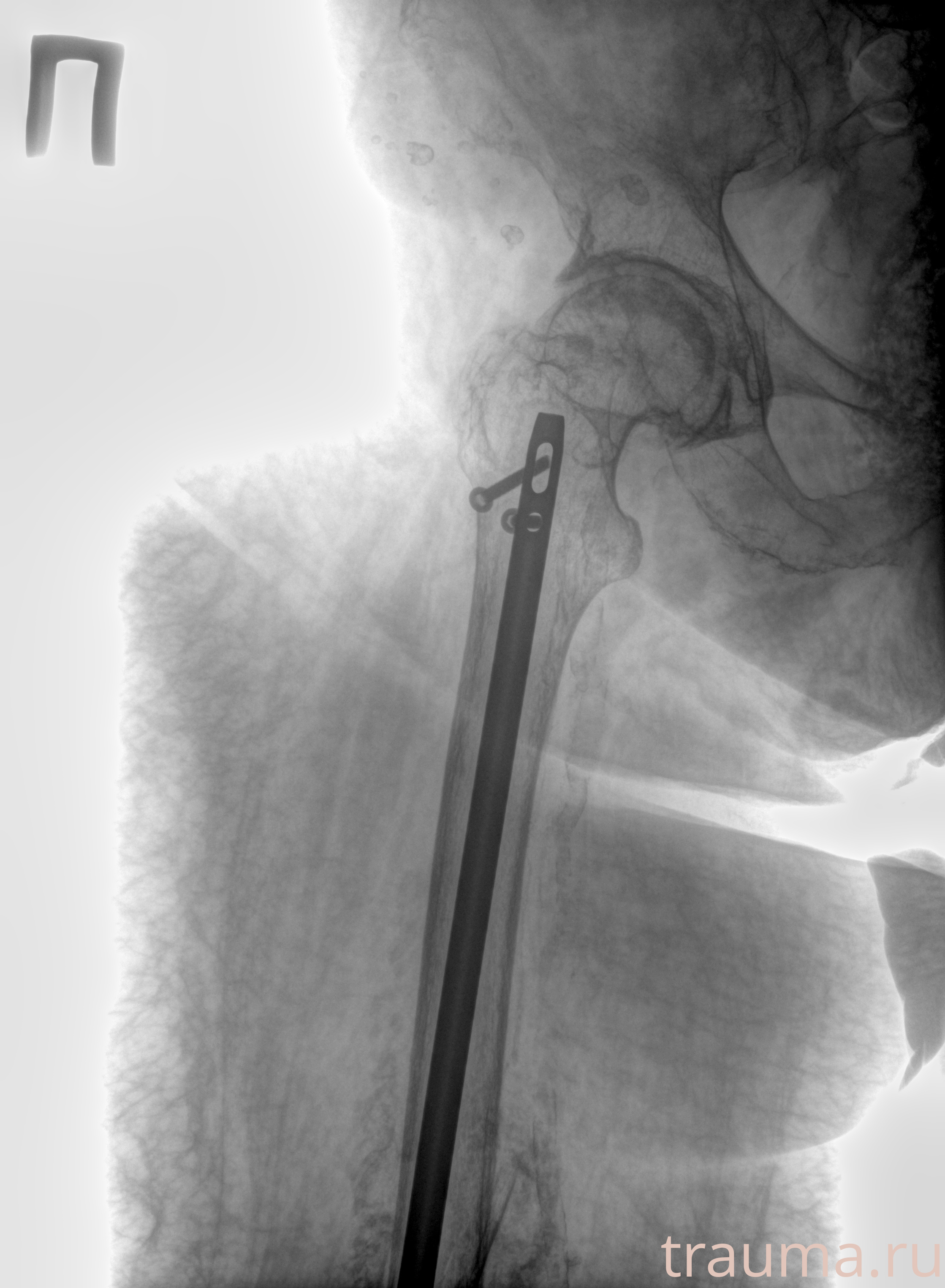 Рентген на дому: по вашему адресу приезжает врач-рентгенолог, травматолог-ортопед с мобильным рентгеновским аппаратом, проводит диагностику травмы или заболевания, делает необходимые рентгенограммы, дает рекомендации по дальнейшему лечению. Получить качественные снимки в домашних условиях возможно благодаря уникальной методике, разработанной МосРентген Центром для института  Склифосовского