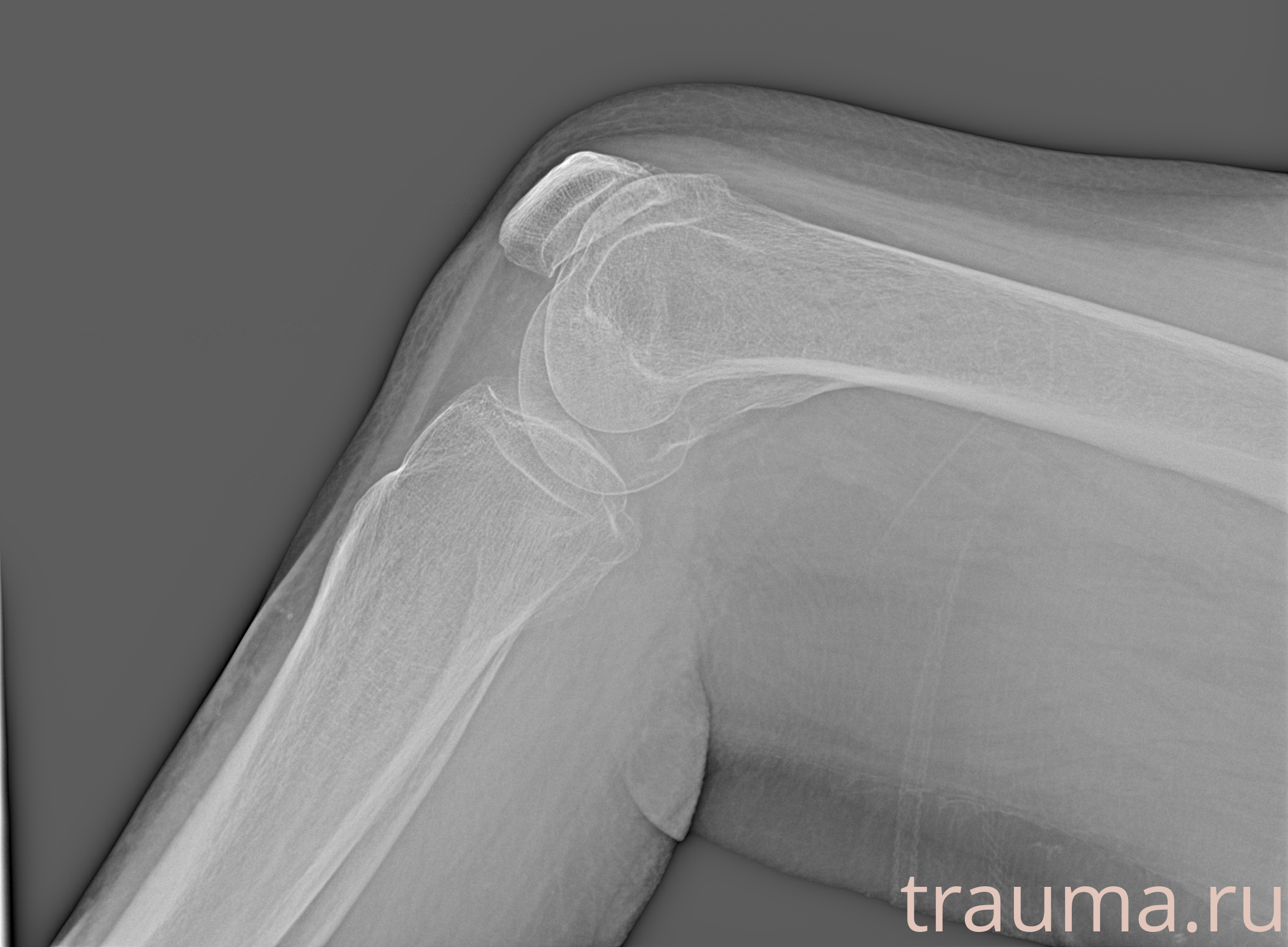 Рентген на дому: по вашему адресу приезжает врач-рентгенолог, травматолог-ортопед с мобильным рентгеновским аппаратом, проводит диагностику травмы или заболевания, делает необходимые рентгенограммы, дает рекомендации по дальнейшему лечению. Получить качественные снимки в домашних условиях возможно благодаря уникальной методике, разработанной МосРентген Центром для института  Склифосовского