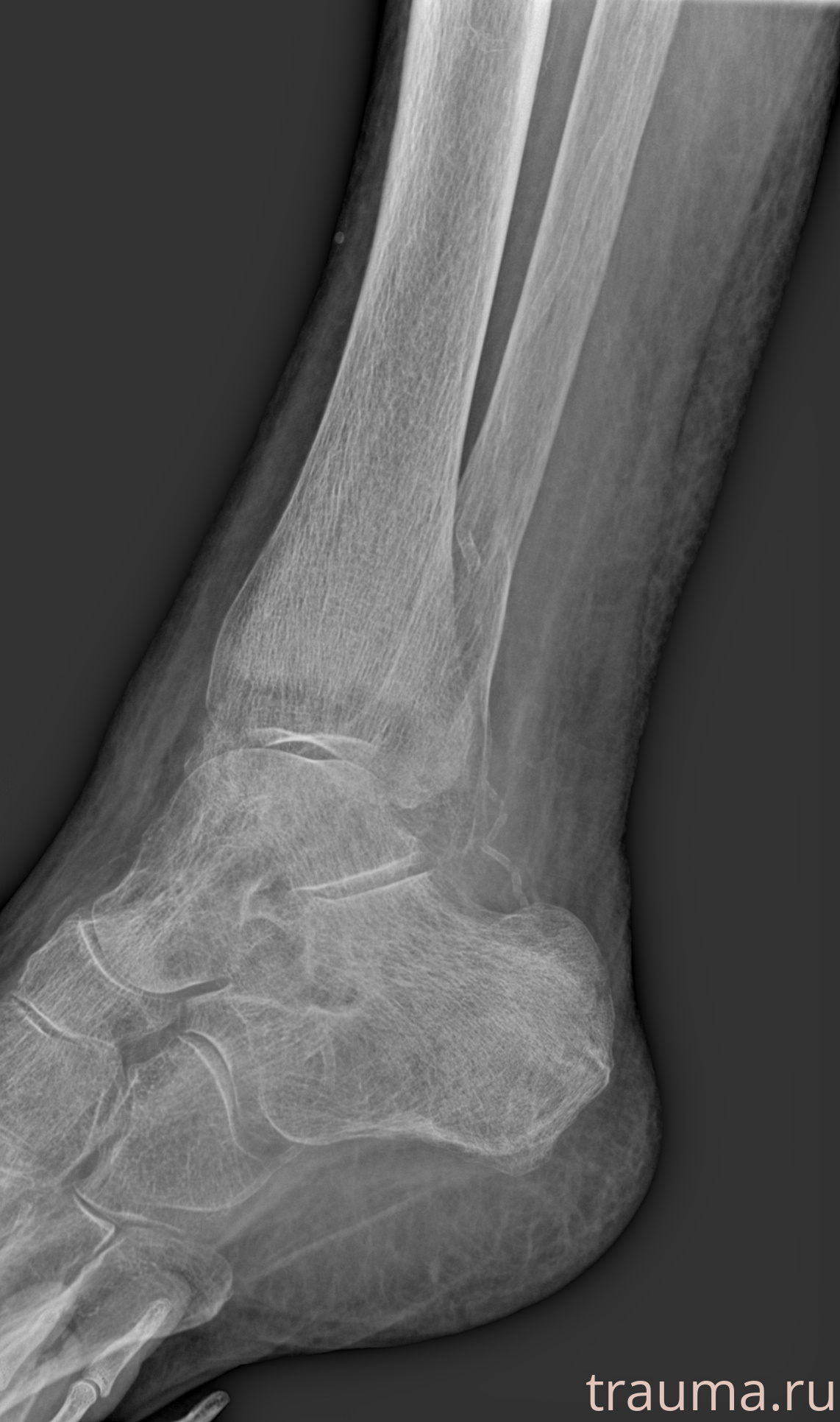 Рентген на дому: по вашему адресу приезжает врач-рентгенолог, травматолог-ортопед с мобильным рентгеновским аппаратом, проводит диагностику травмы или заболевания, делает необходимые рентгенограммы, дает рекомендации по дальнейшему лечению. Получить качественные снимки в домашних условиях возможно благодаря уникальной методике, разработанной МосРентген Центром для института  Склифосовского